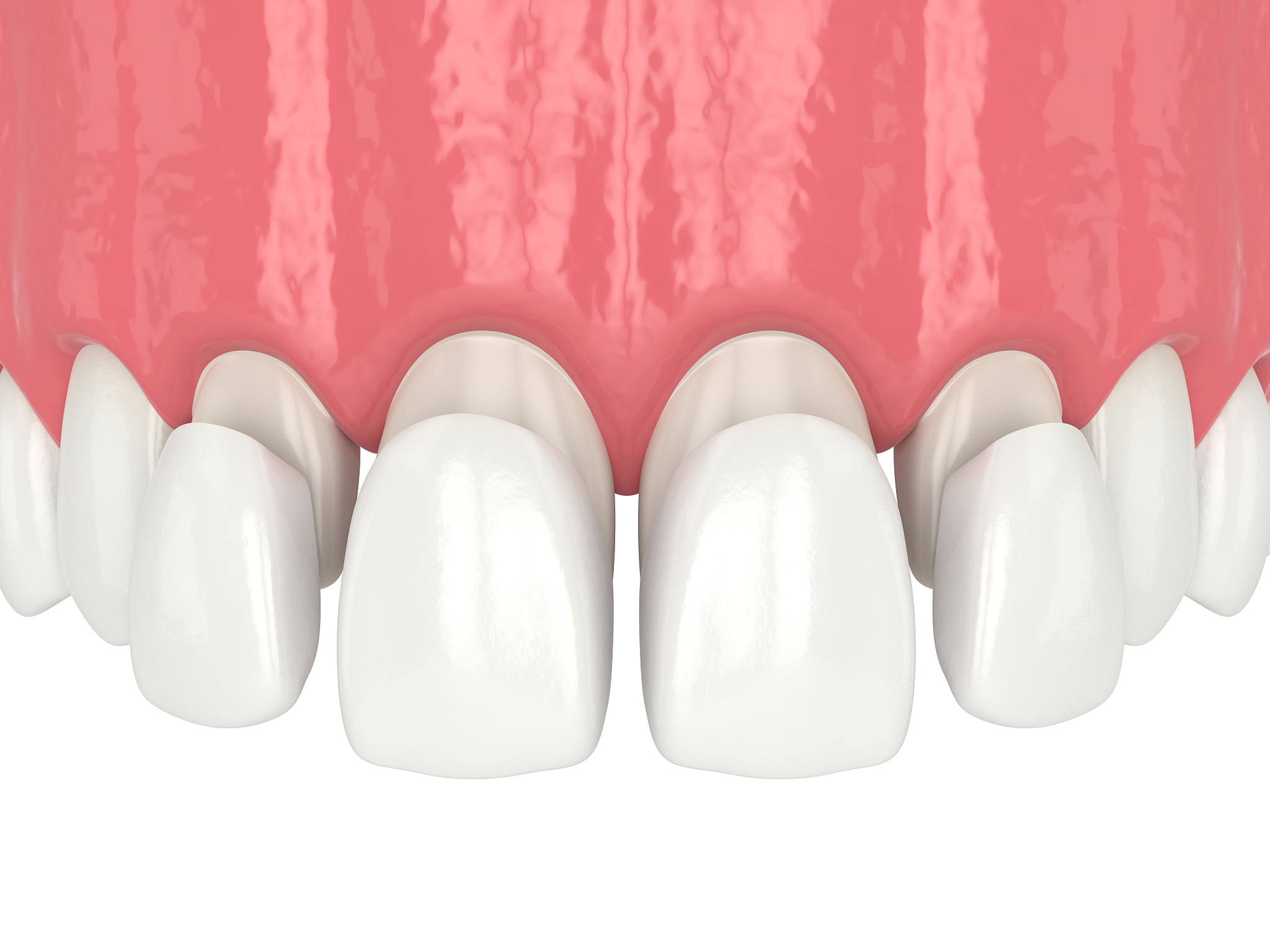 3d render of upper jaw with four veneers