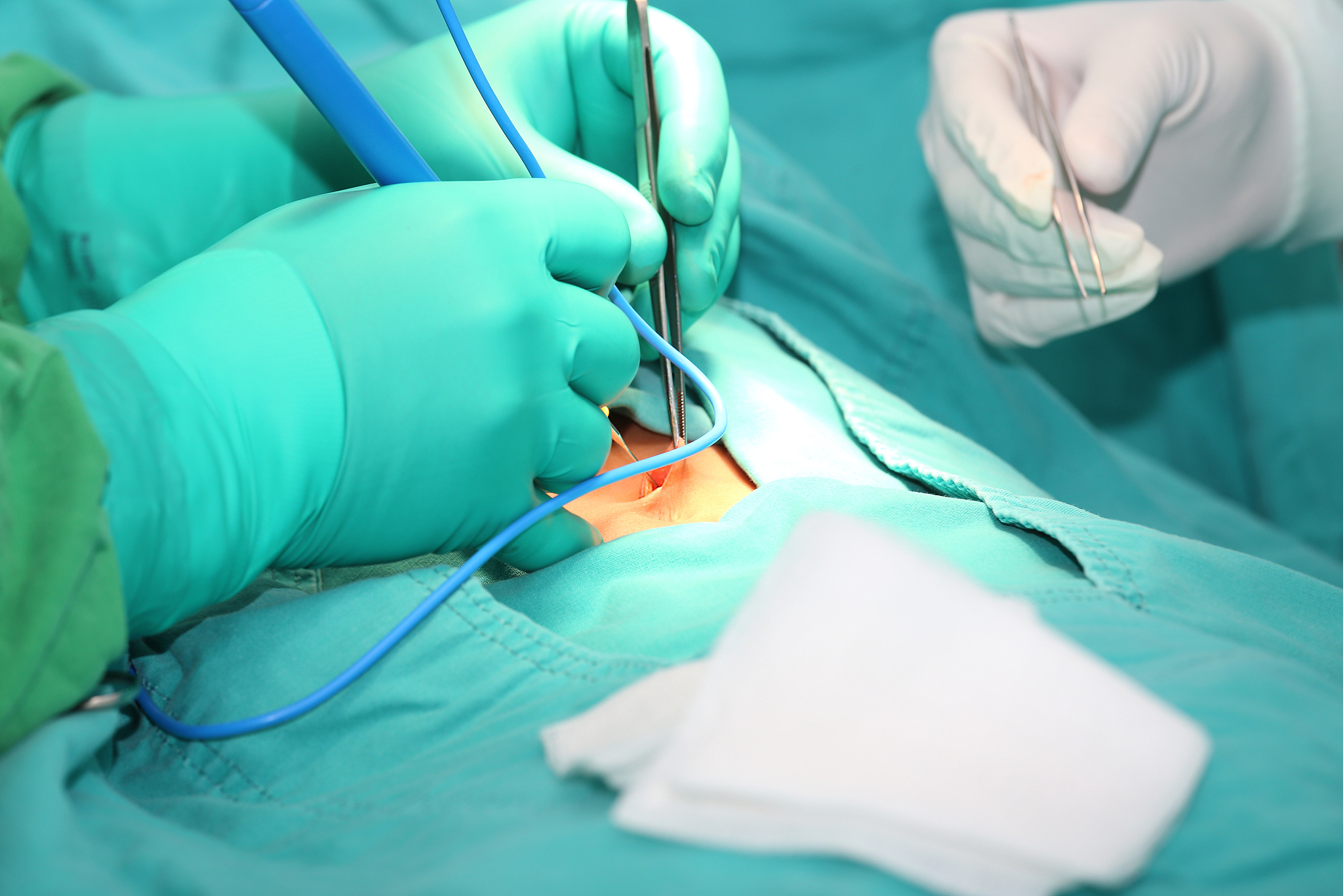 doctor using an electronic scalpel in a surgery