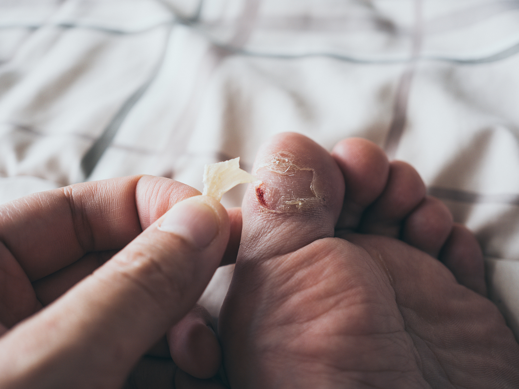 足底鸡眼治疗方案：去除鸡眼疼痛的多种方法