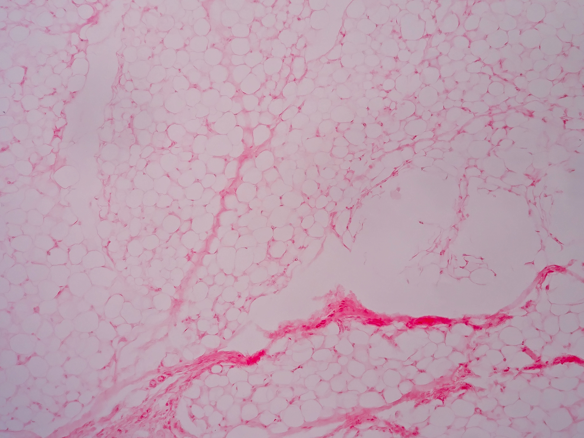 续写答案解析：向心性肥胖是由于下列哪一种激素泌过多所致A生长素B胰岛素C糖皮质激素D盐皮质激素答案：C解析：糖皮质激素促进体内脂肪重新布主要沉积在面、颈、躯干、和腹部而四肢
