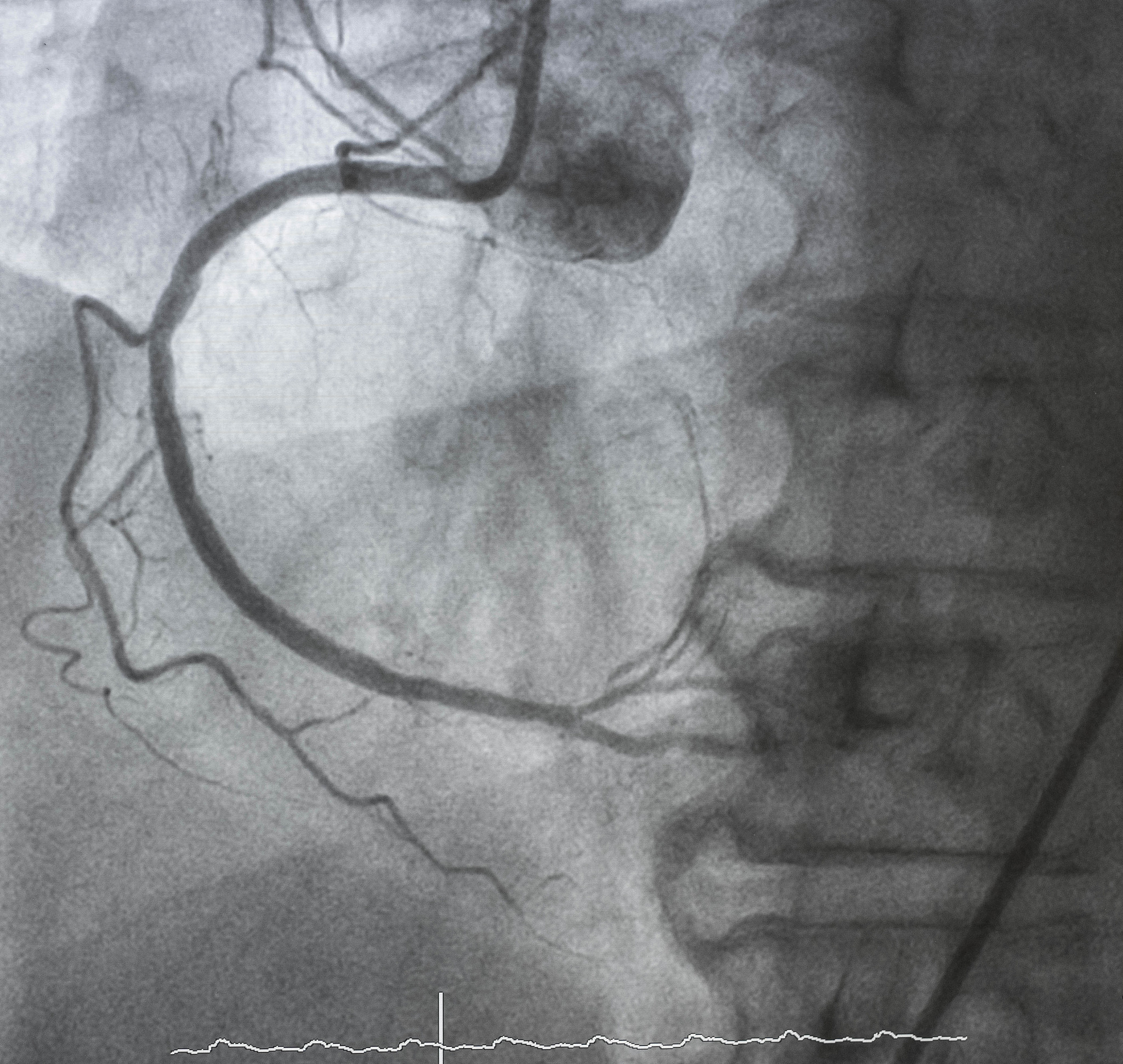 Intraoperative perforation was defined as rupture of the serosa during ESD while delayed perforation was defined as sudden abdominal pain with intraperitoneal free gas on abdominal CT scan翻译成中文