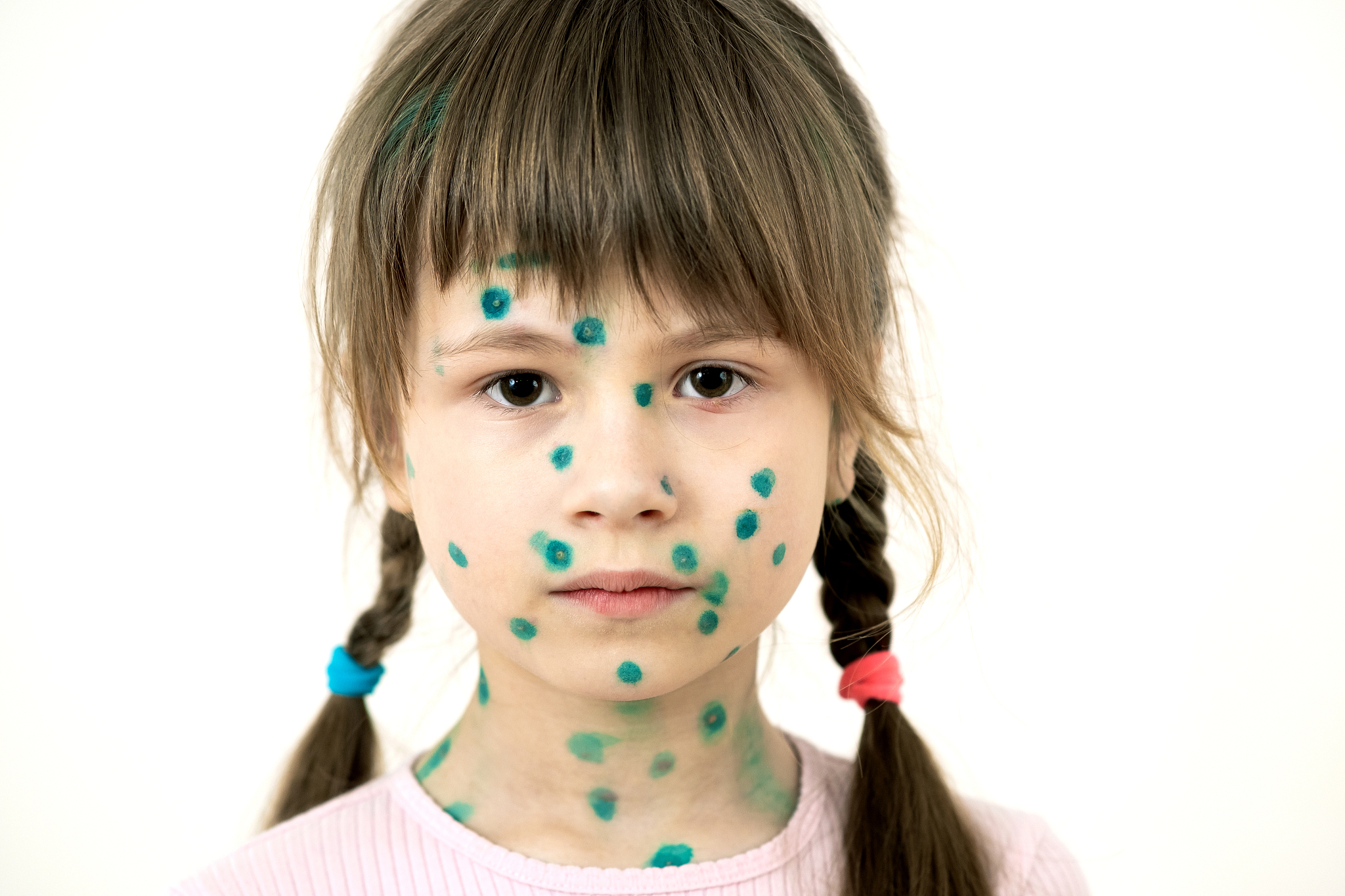 高危妊娠中孕前或孕期感染如巨细胞病毒、风疹、梅毒等。