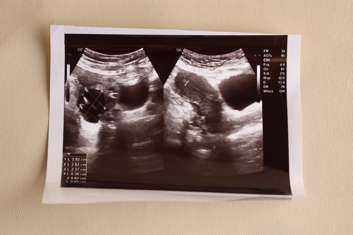 产后妇女前盆腔评估：经会阴超声技术的应用与评价