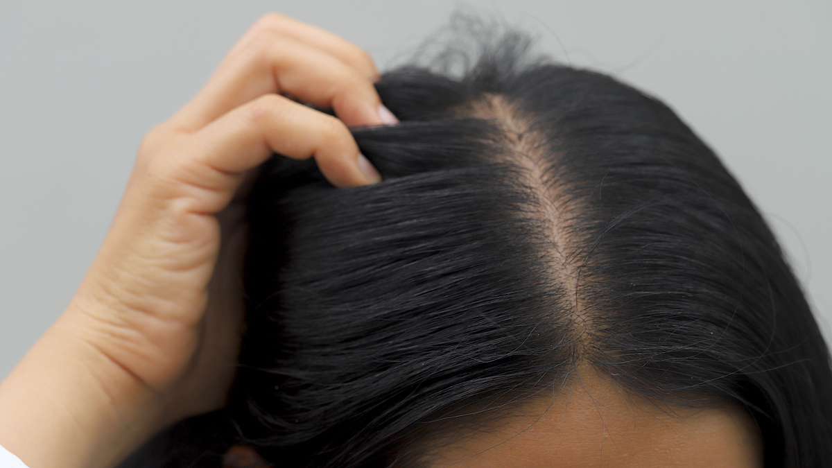 染头发后头皮比较容易痒怎么办？