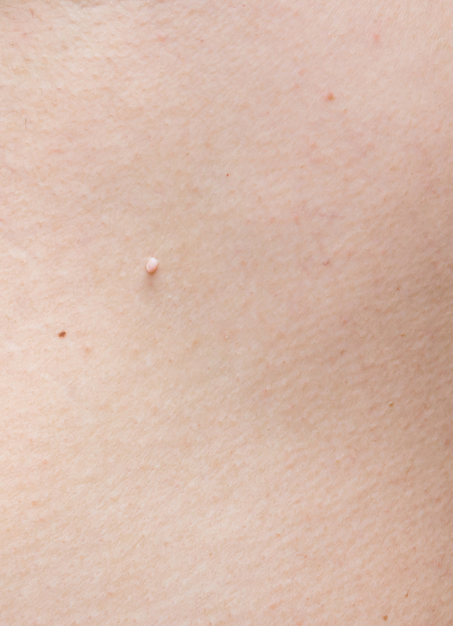 pedunculated skin tag or acrochondon or soft fibroma. papilloma 