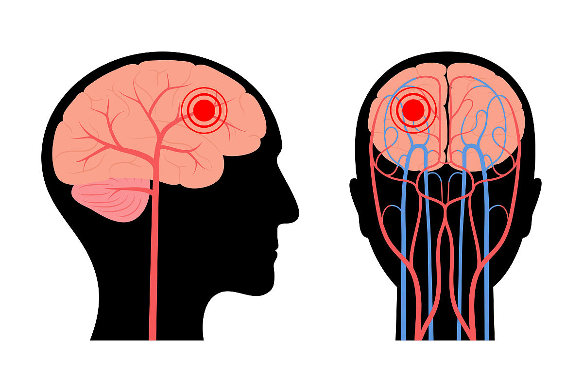 精神分裂症会导致癫痫吗？ 了解两者关系