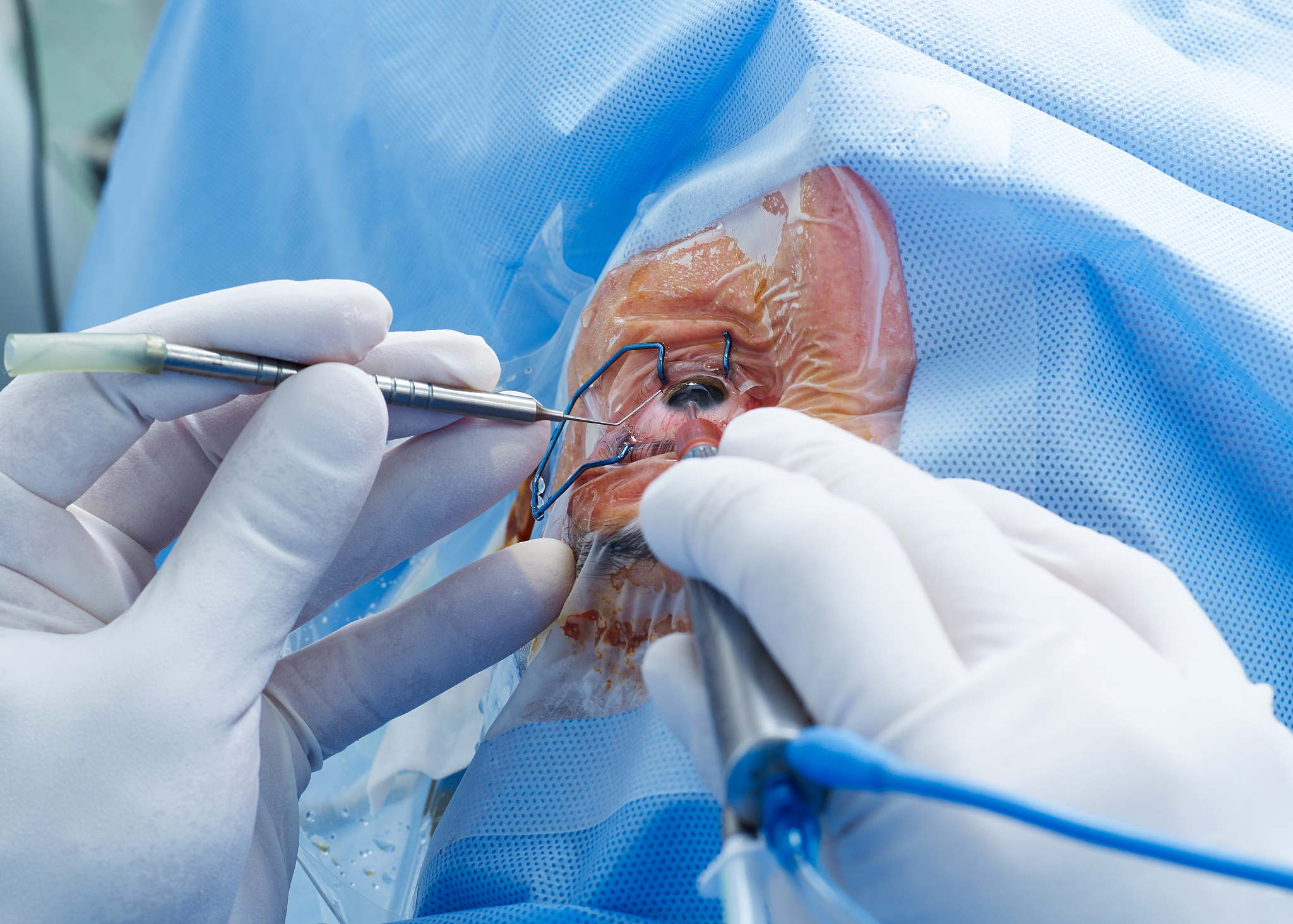 eye surgery close-up