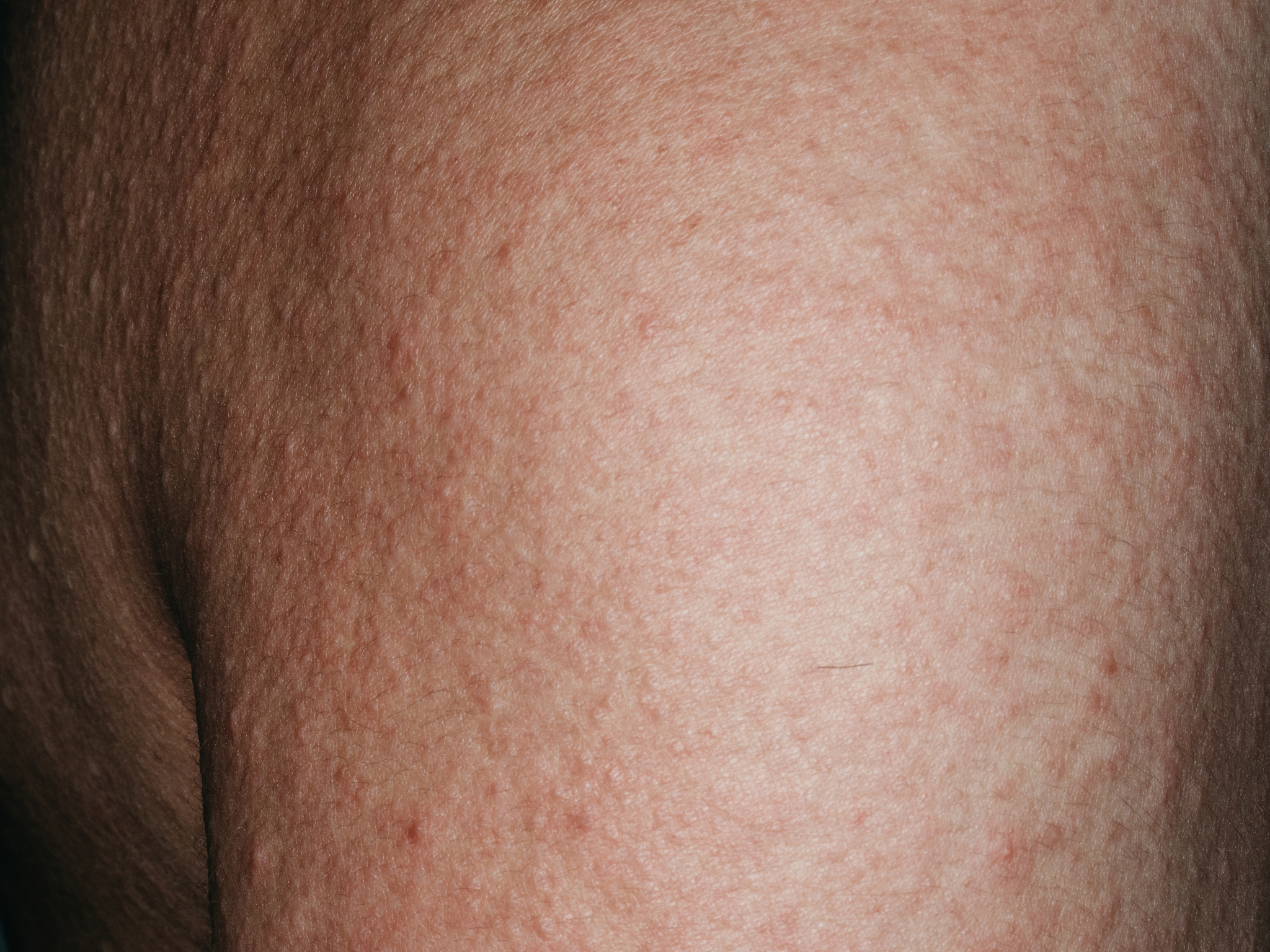 全身剧烈过敏怎么办？症状、原因及急救措施