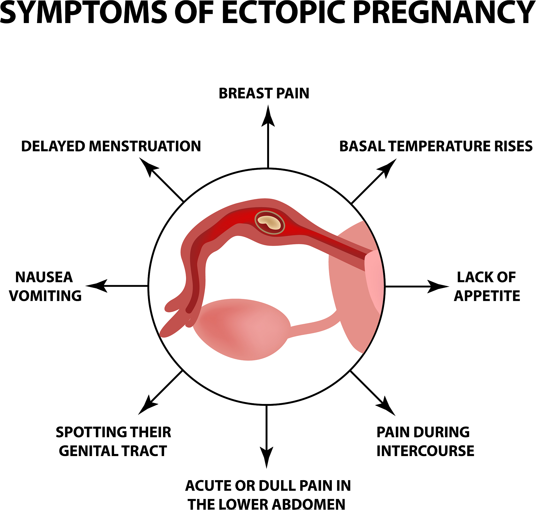 生化流产：症状、原因和月经周期影响