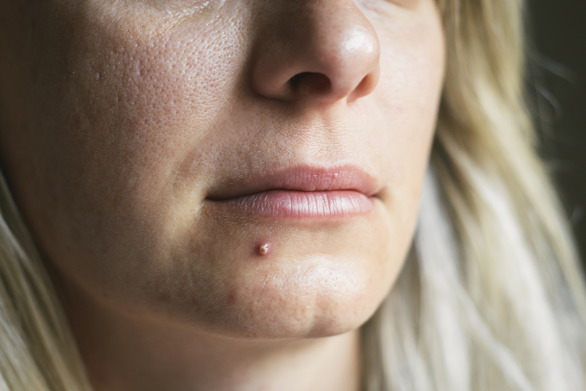 白人脸上为什么会长斑，