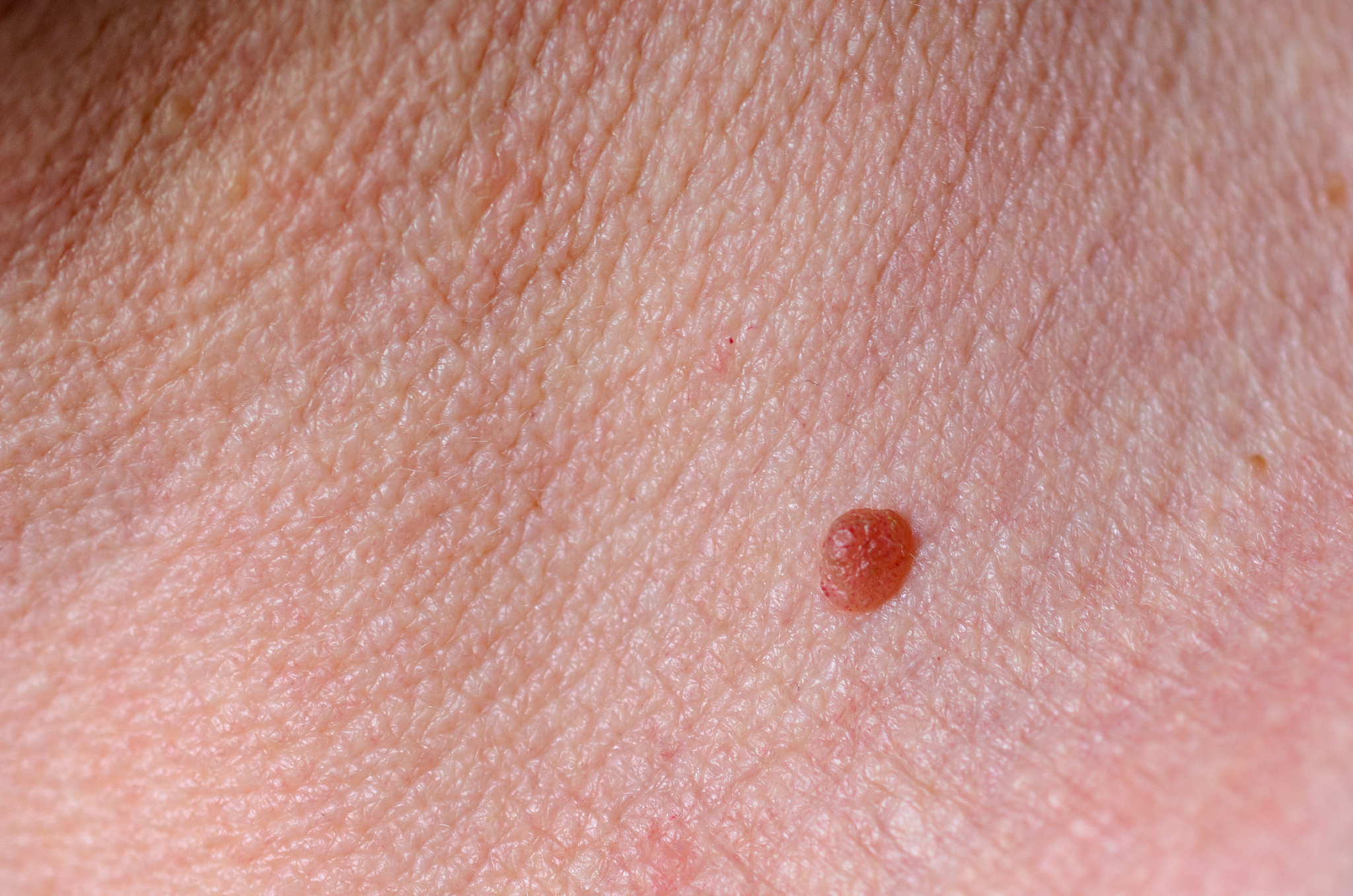 benign skin lesion, pigmented naevus, inborn mole. health concep