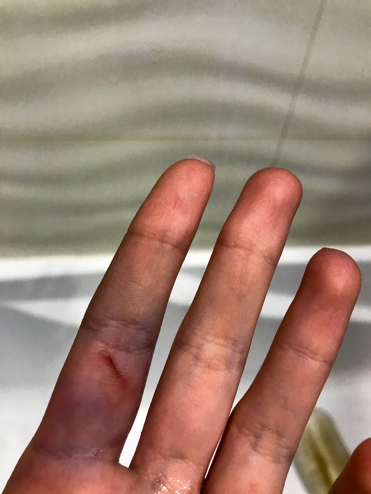 手部软组织感染：症状、治疗及预防