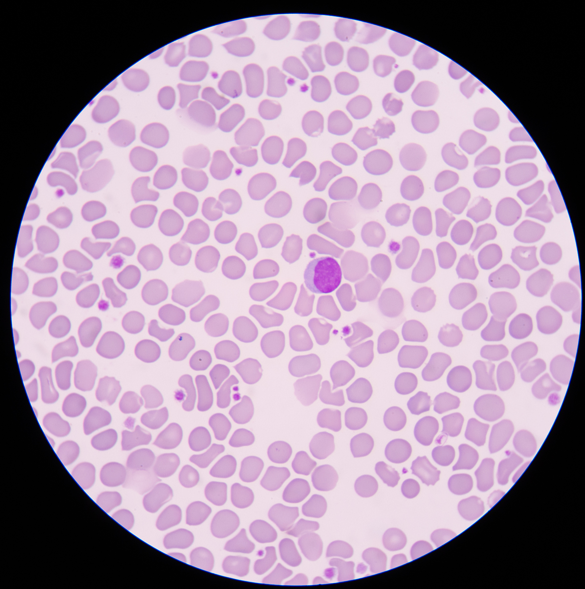 肾小球疾病时水肿、高血压的发生机制