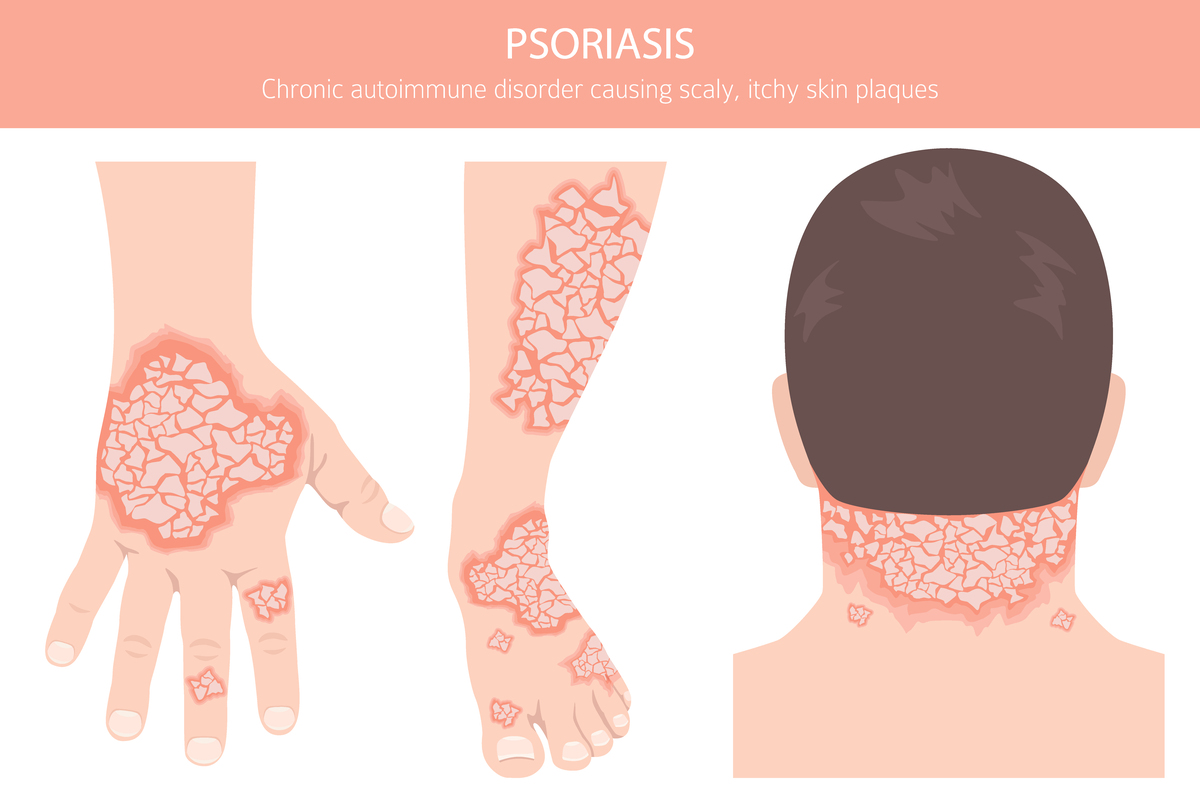 泛发性脓疱型银屑病：症状、治疗及生活护理