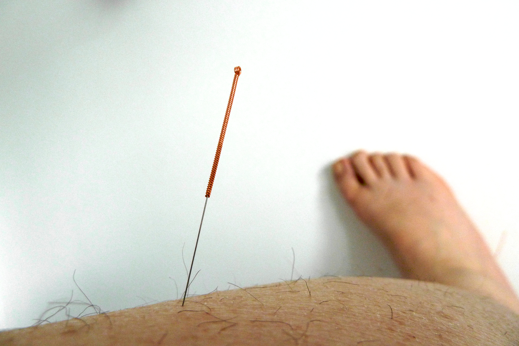 close-up of person with acupuncture needle
