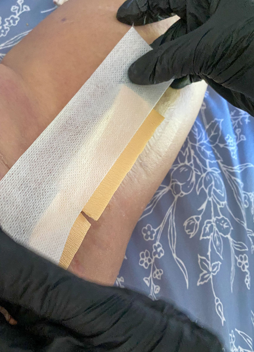 挤压钉固定缝线技术：降低术后并发症，提升关节稳定性