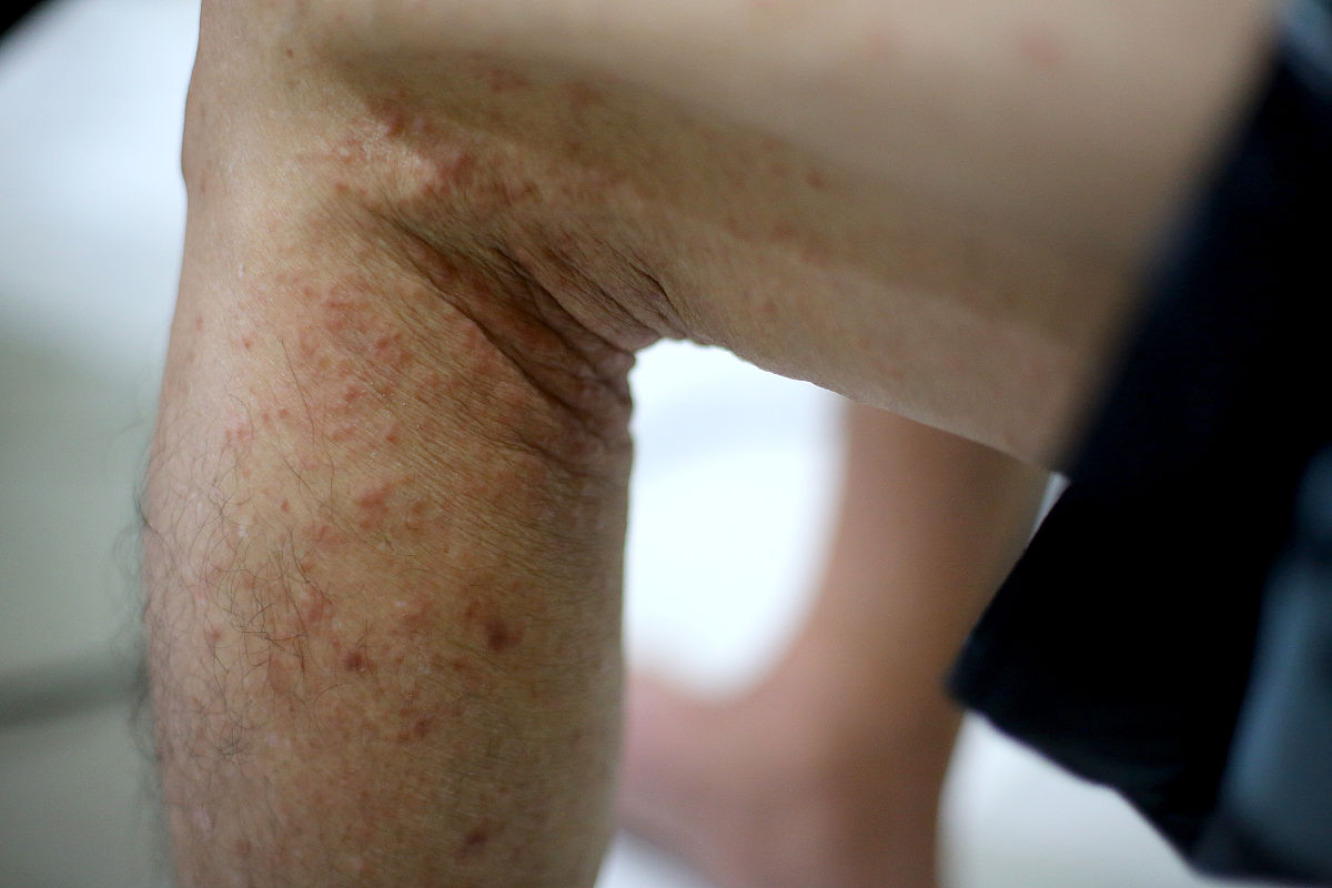 这是什么皮肤病：病灶处干燥蜕皮有时会痒抓了之后会疼渗出无色透明液体而且更痒