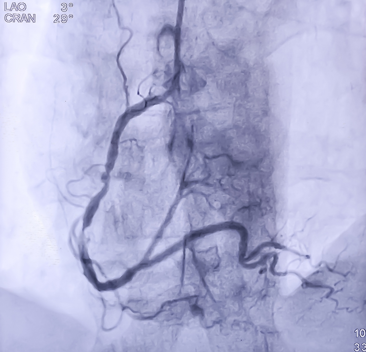 右颈动脉破裂易损斑块：诊断、治疗及预后