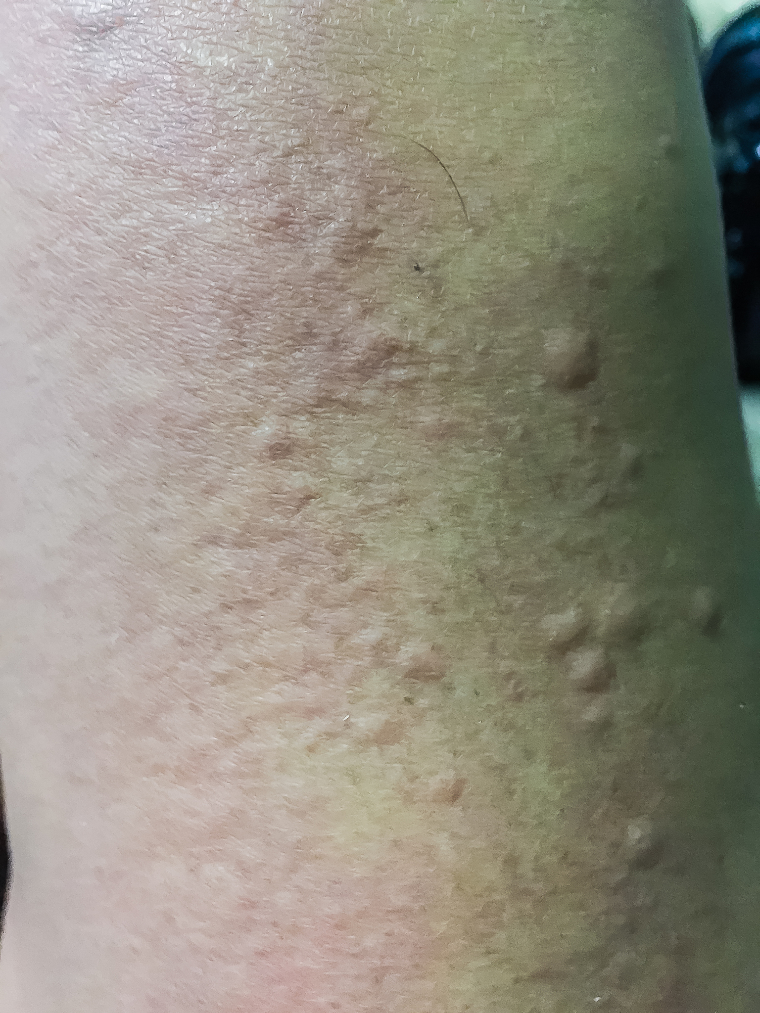 close up view of cold urticaria allergic rash. symptoms of itchy