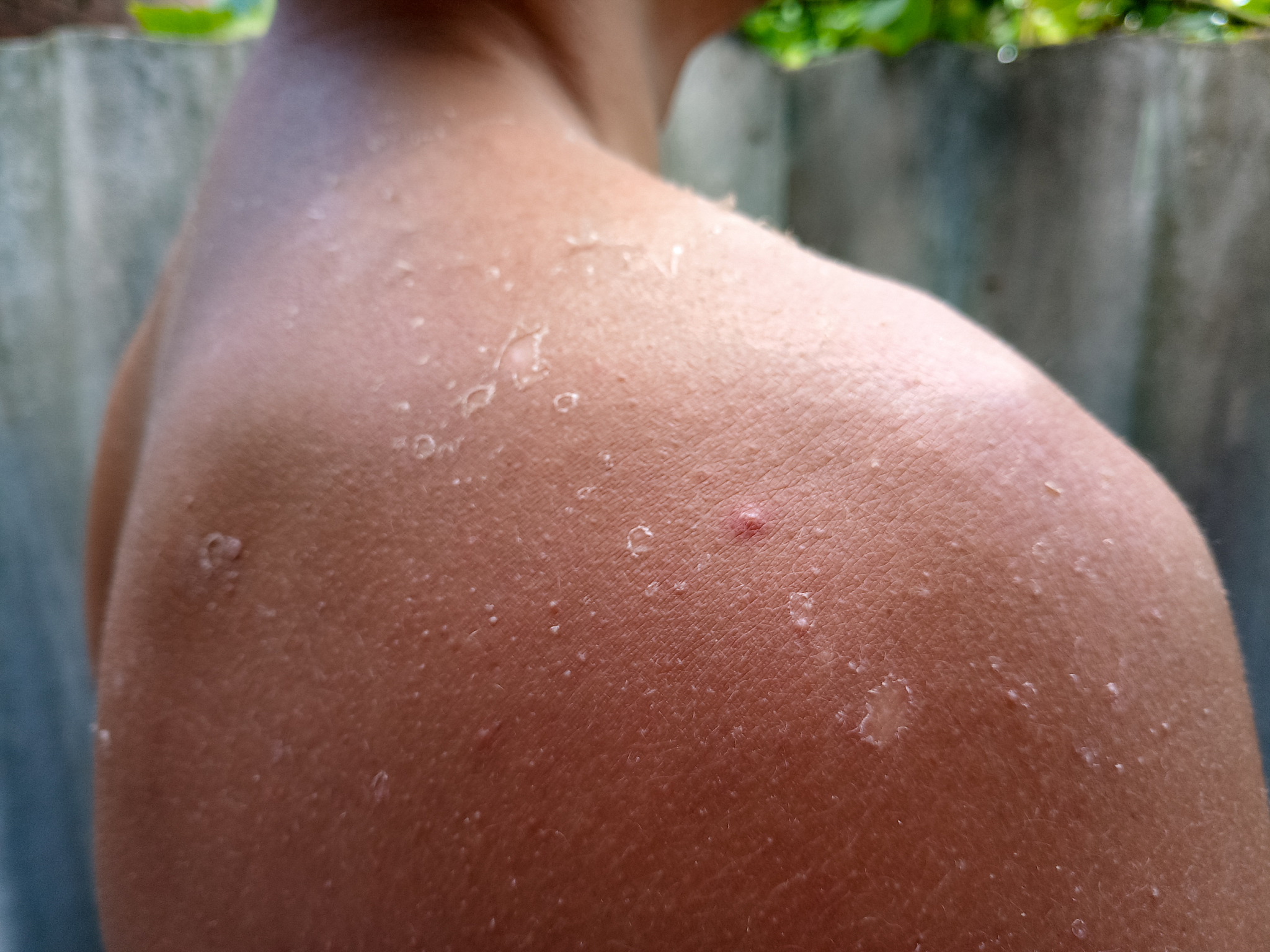 exfoliation of the skin after sunburn. excessive tan.