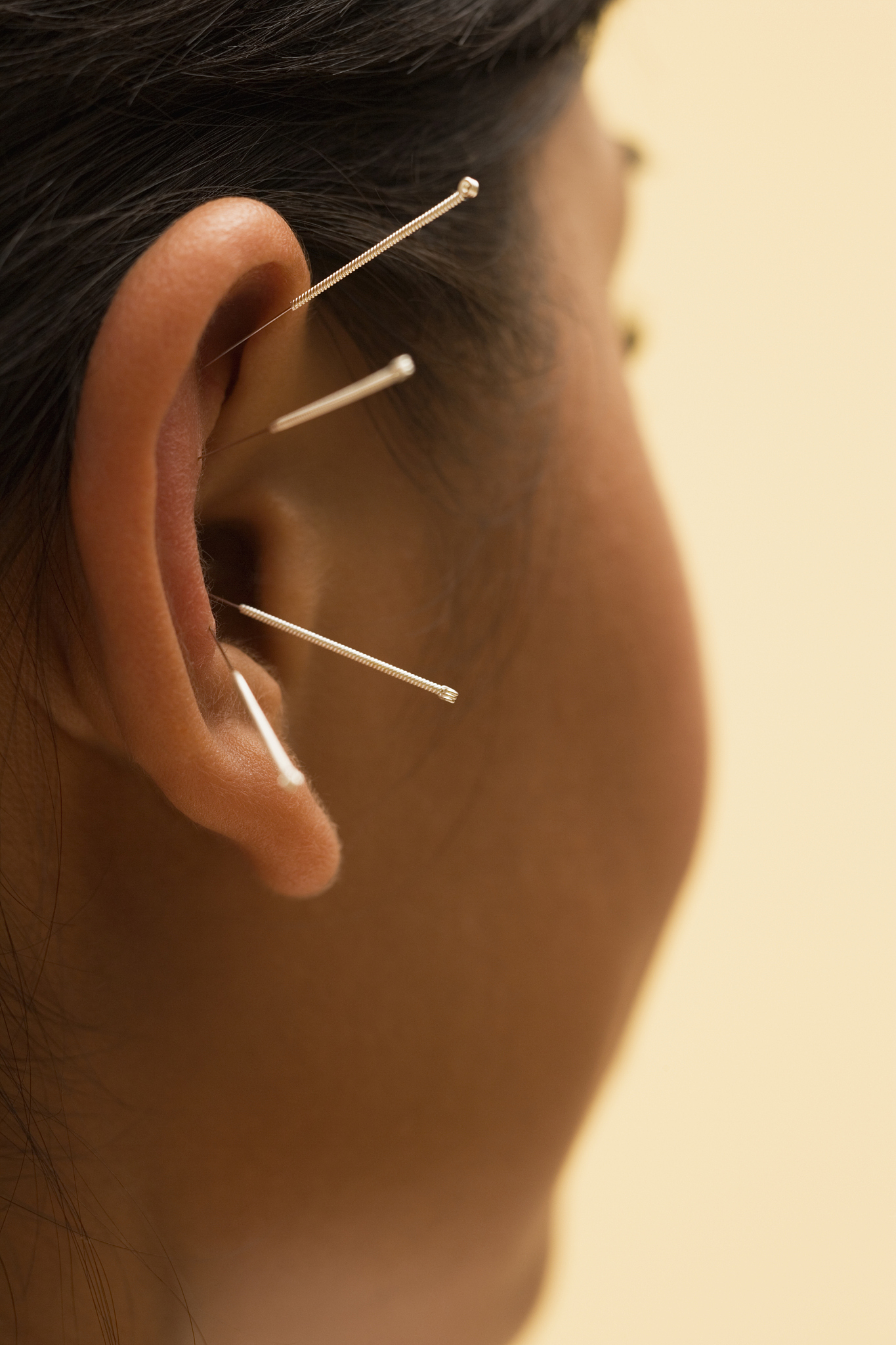 young woman getting acupuncture treatment