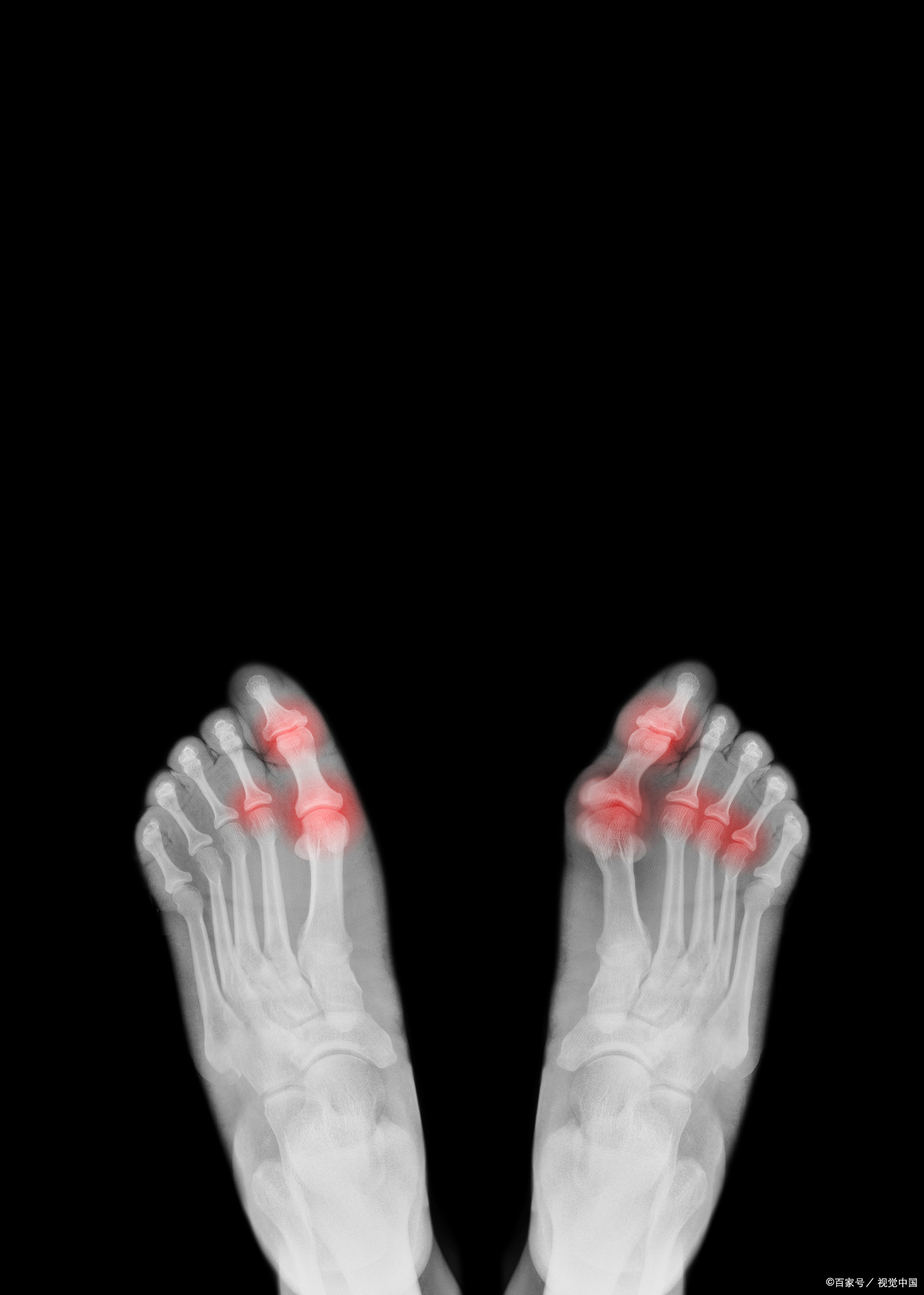 自限性和剧烈疼痛为特点的无菌性炎症,发病部位大多位于第一跖趾关节