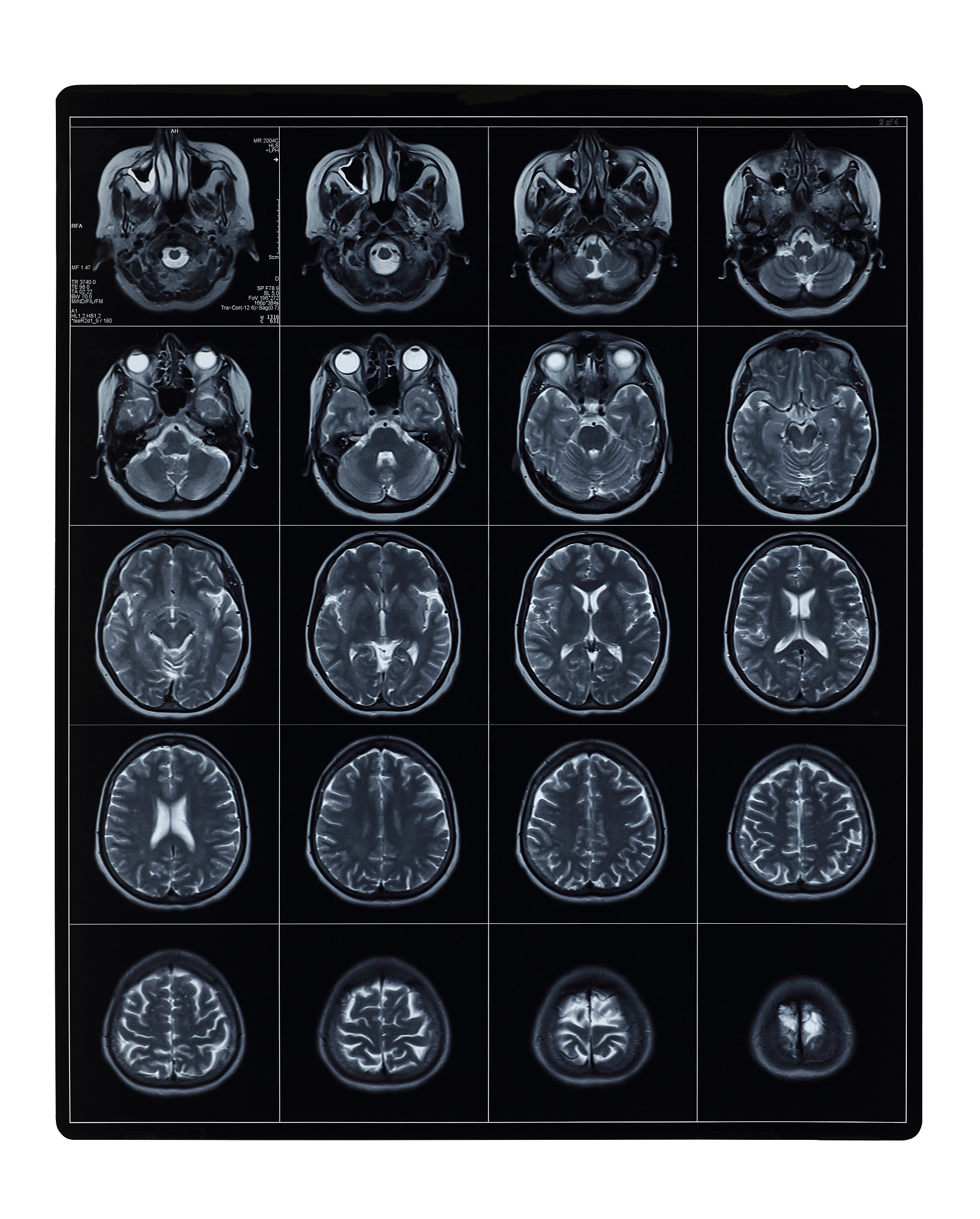 解密磁共振FLAIR图像：为何脑脊液信号会变低？