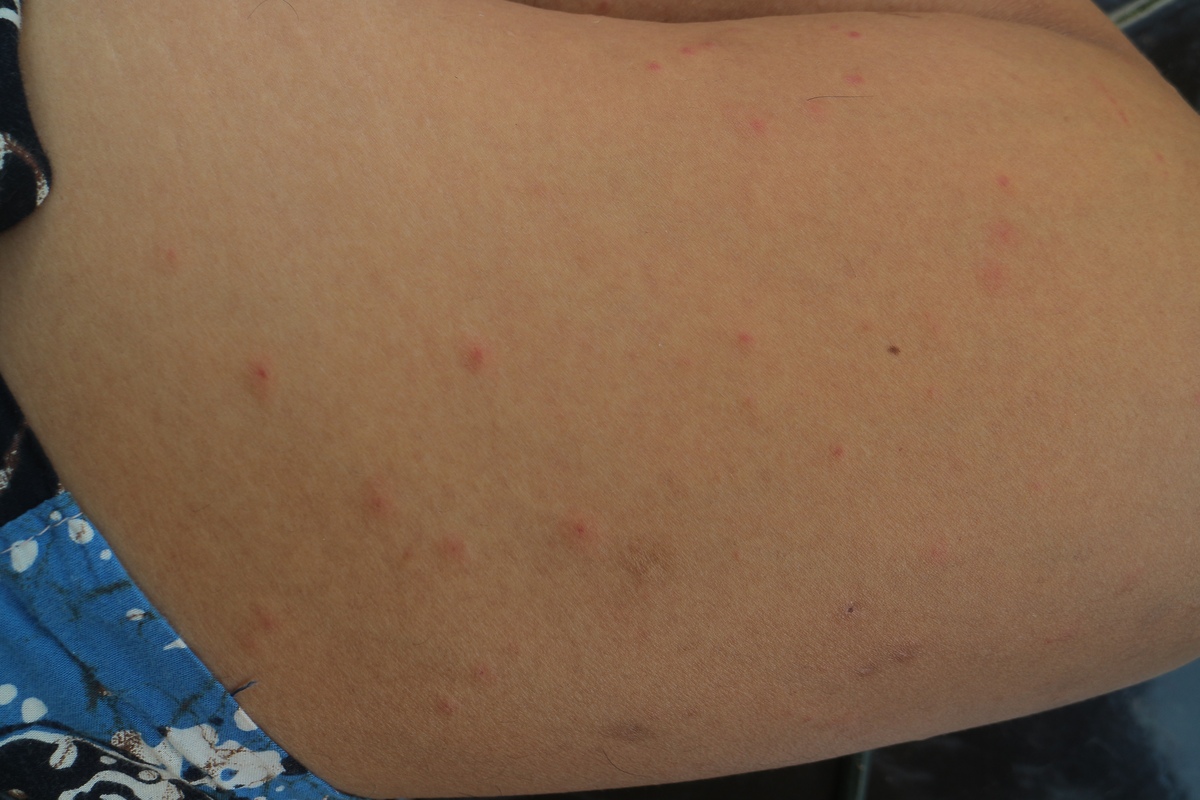 手臂长红痘痘很痒