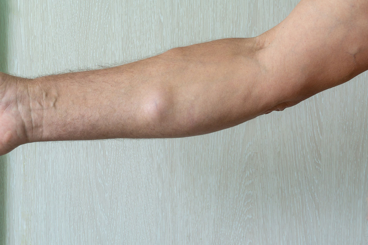 脂肪瘤要手术切除吗？