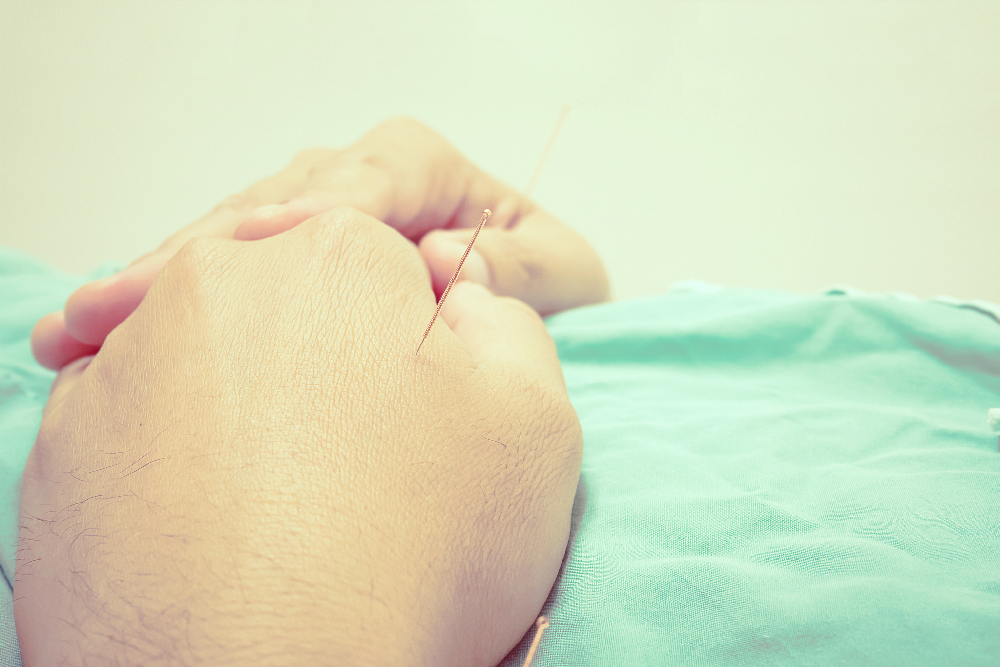 close-up of person with acupuncture needles