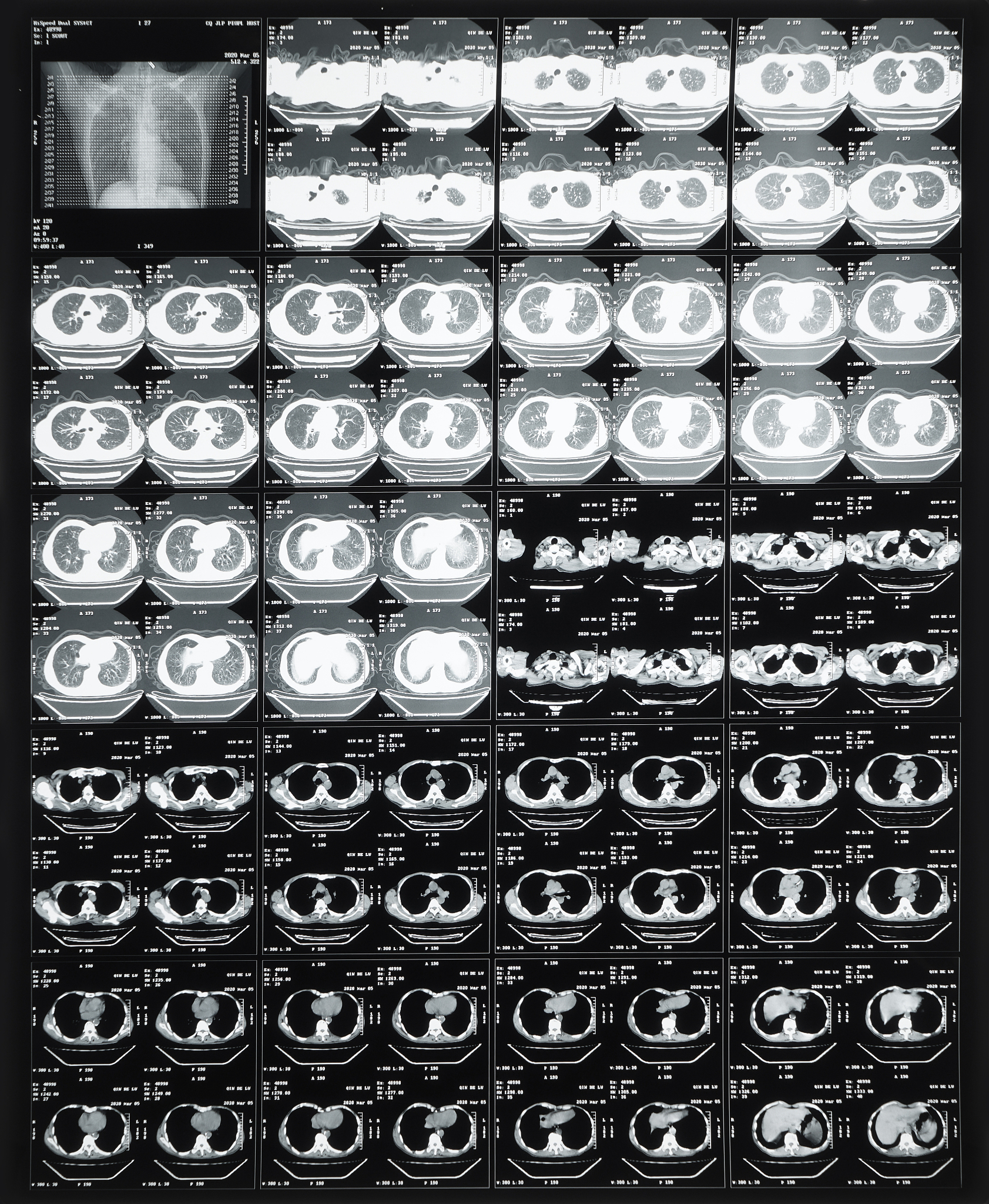 胸腰椎管内多发神经鞘瘤：一篇文献综述