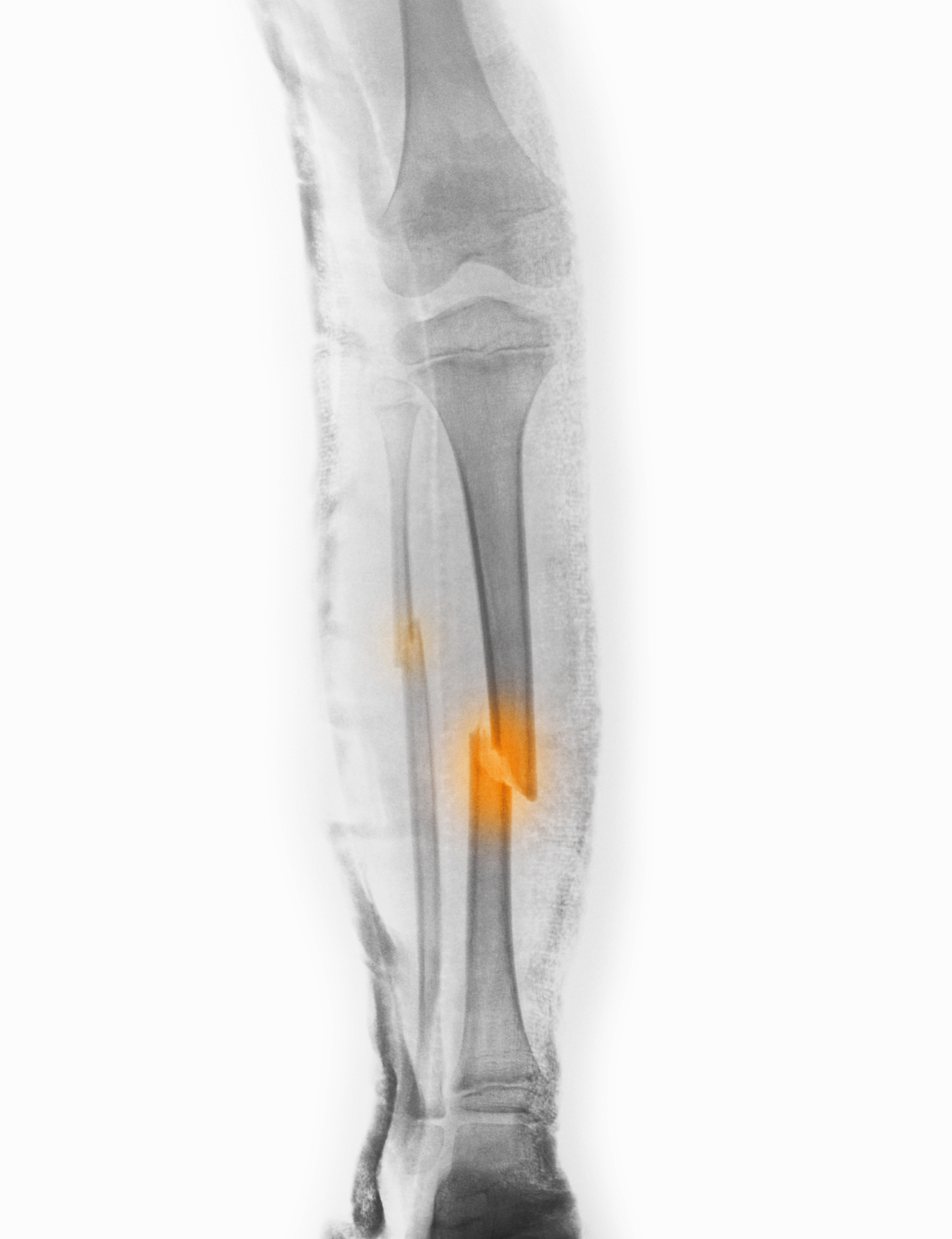 小腿骨折症状1 疼痛：小腿骨折时会感到剧烈的疼痛尤其是在受伤部位。2 肿胀：小腿骨折后周围的软组织可能会肿胀导致肿胀和疼痛。3 瘀伤：小腿骨折时周围的皮肤可能会出现瘀伤或淤血的迹象。4 受伤部位变形：小腿骨折时受伤部位可能会出现明显的变形如突起或凹陷。5 无法支撑体重：玉蒲团小腿骨折后患者可能会感到无法支撑体重不能正常行走。6 活动范围受限：小腿骨折后患者可能会感到运动和活动的范围受到限制因为骨折