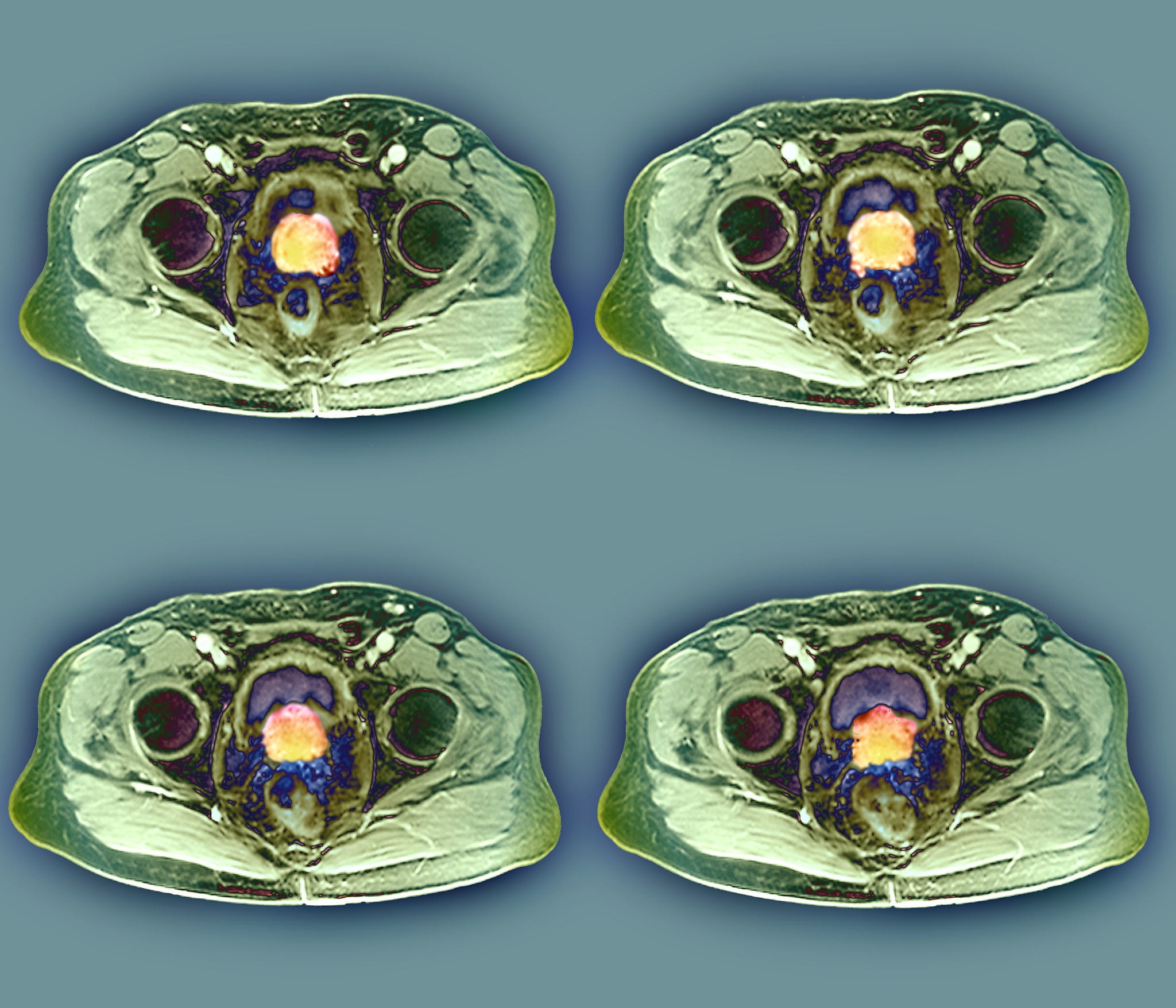 Lacunar Infarction and Carotid Artery Stenosis: A Case Report