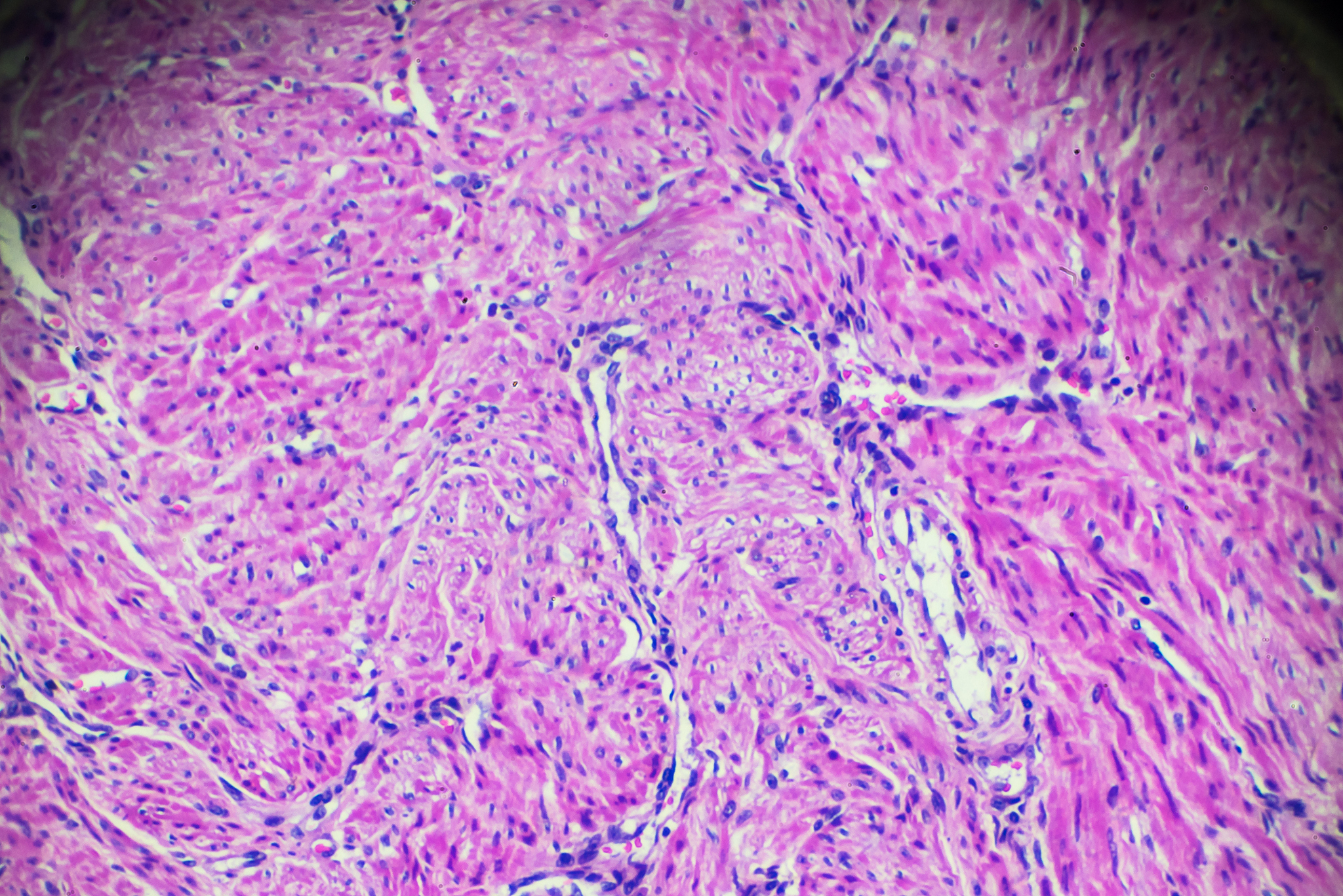 早期子宫内膜癌的需要腹主动脉淋巴结活检的包括以下哪几种情况A、乳头状浆液性腺癌B、子宫内膜样腺癌G3C、肌层浸润212D、灶累及宫腔面积超过50或有峡部累及