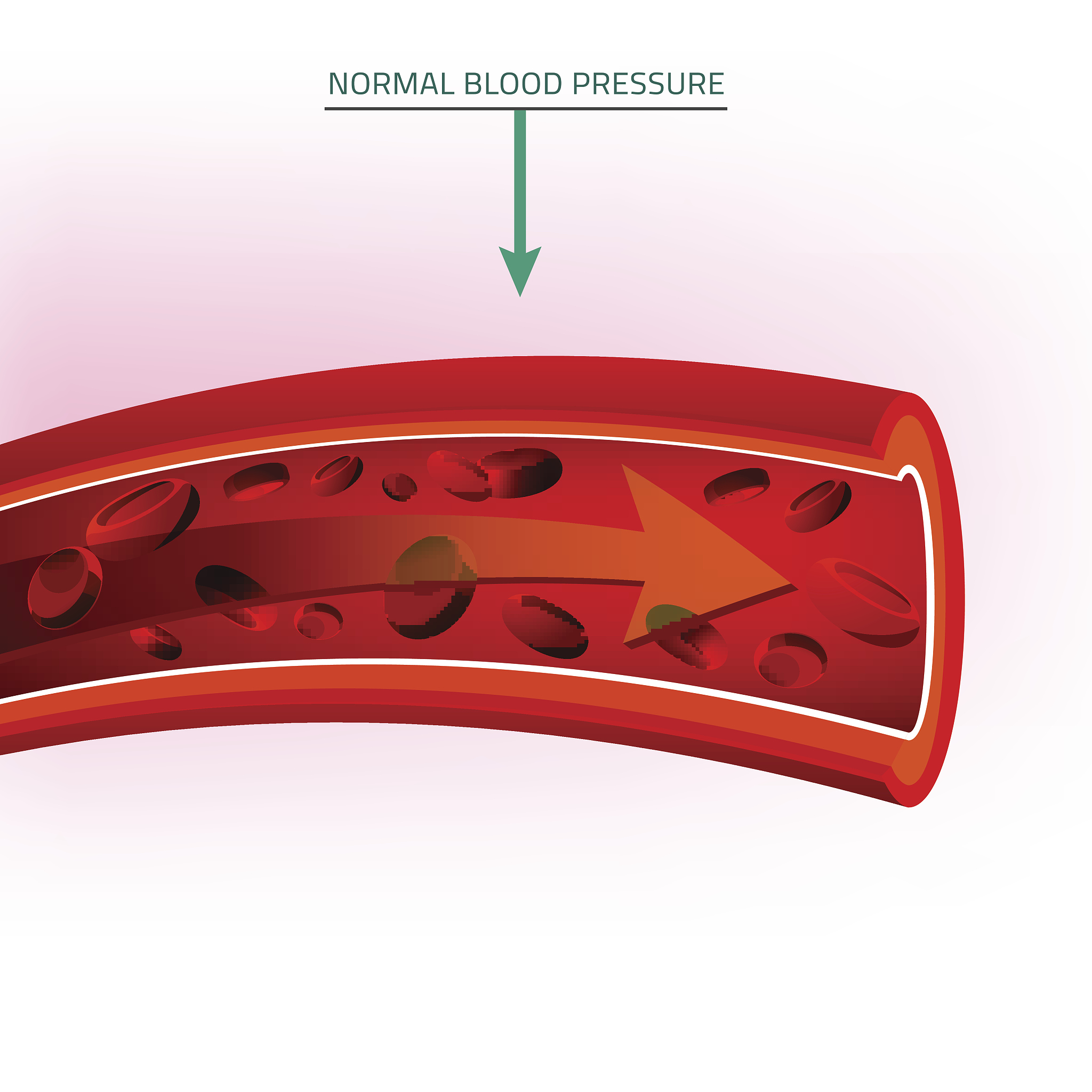 侧脑室周围脑白质慢性缺血缺氧性改变：病因、预防和治疗
