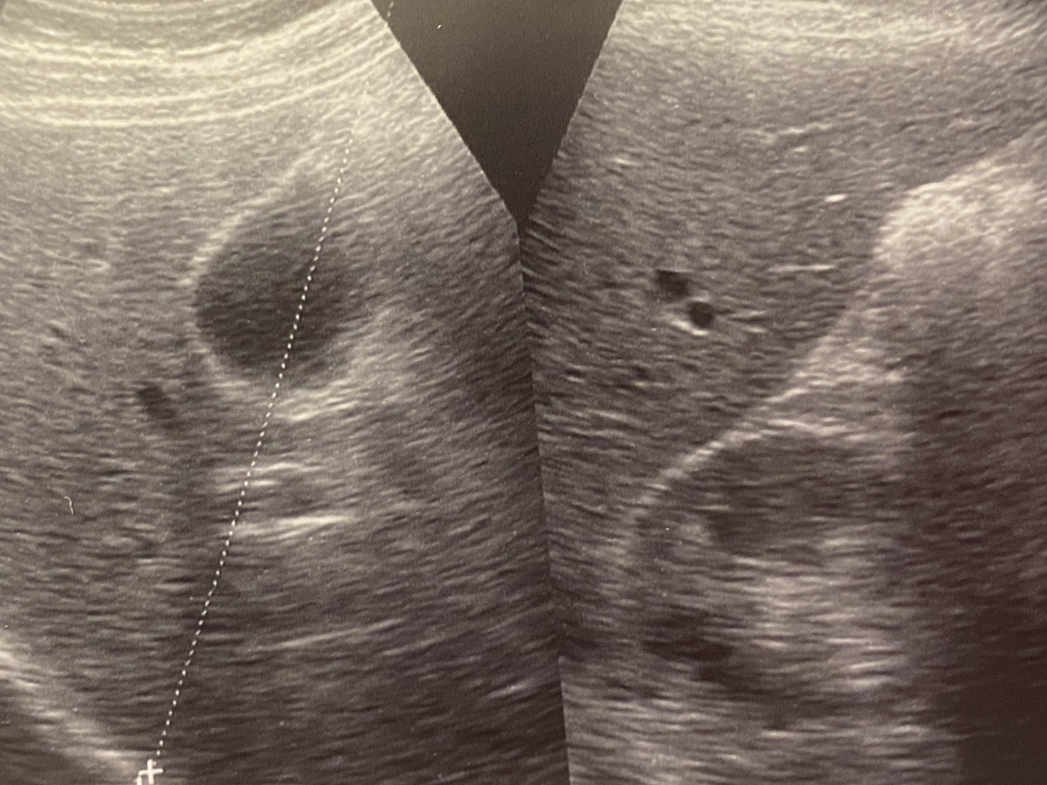 超声造影检查：明确诊断的辅助手段