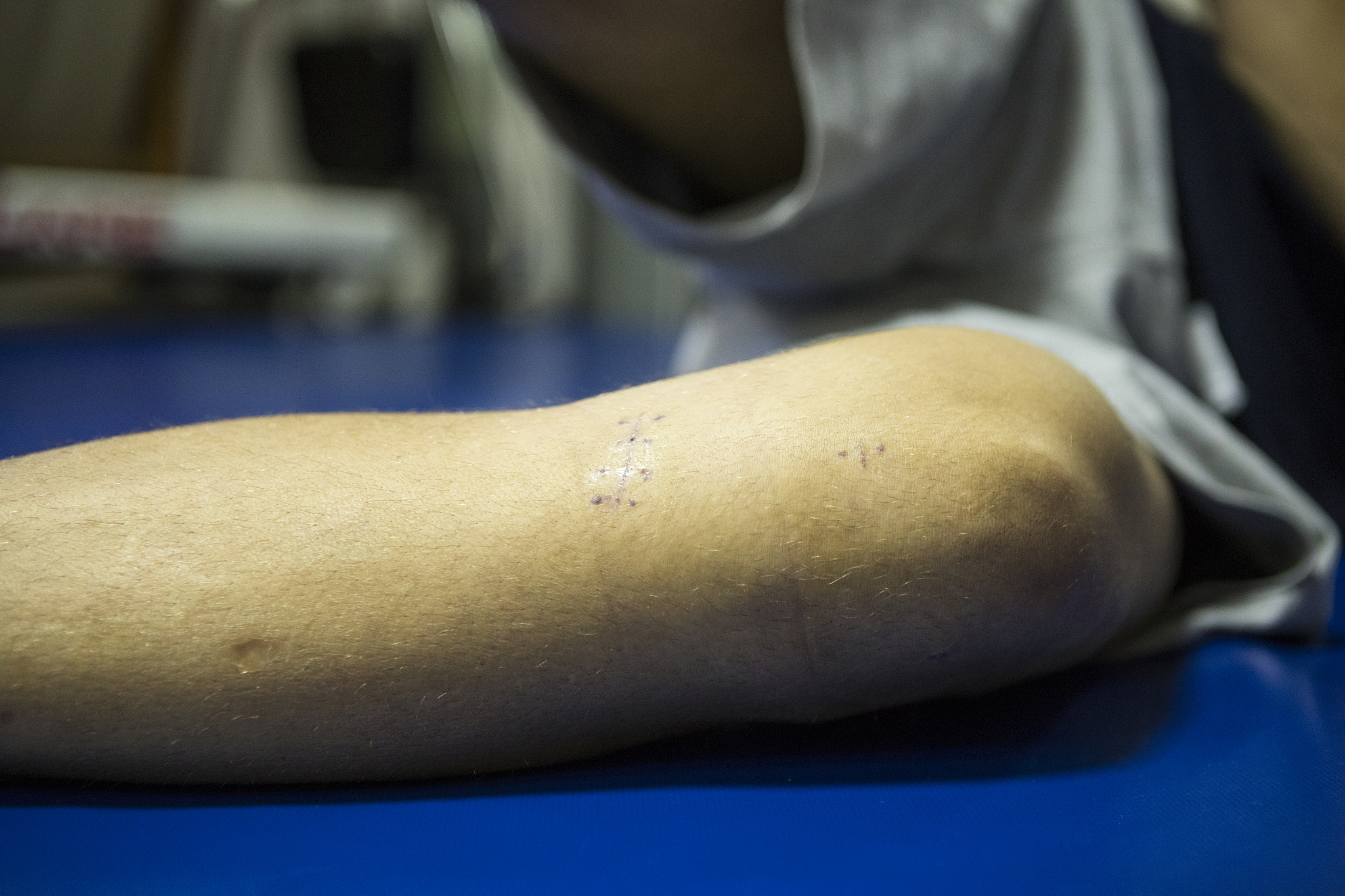 全关节镜治疗距腓前韧带损伤：最新进展与优势