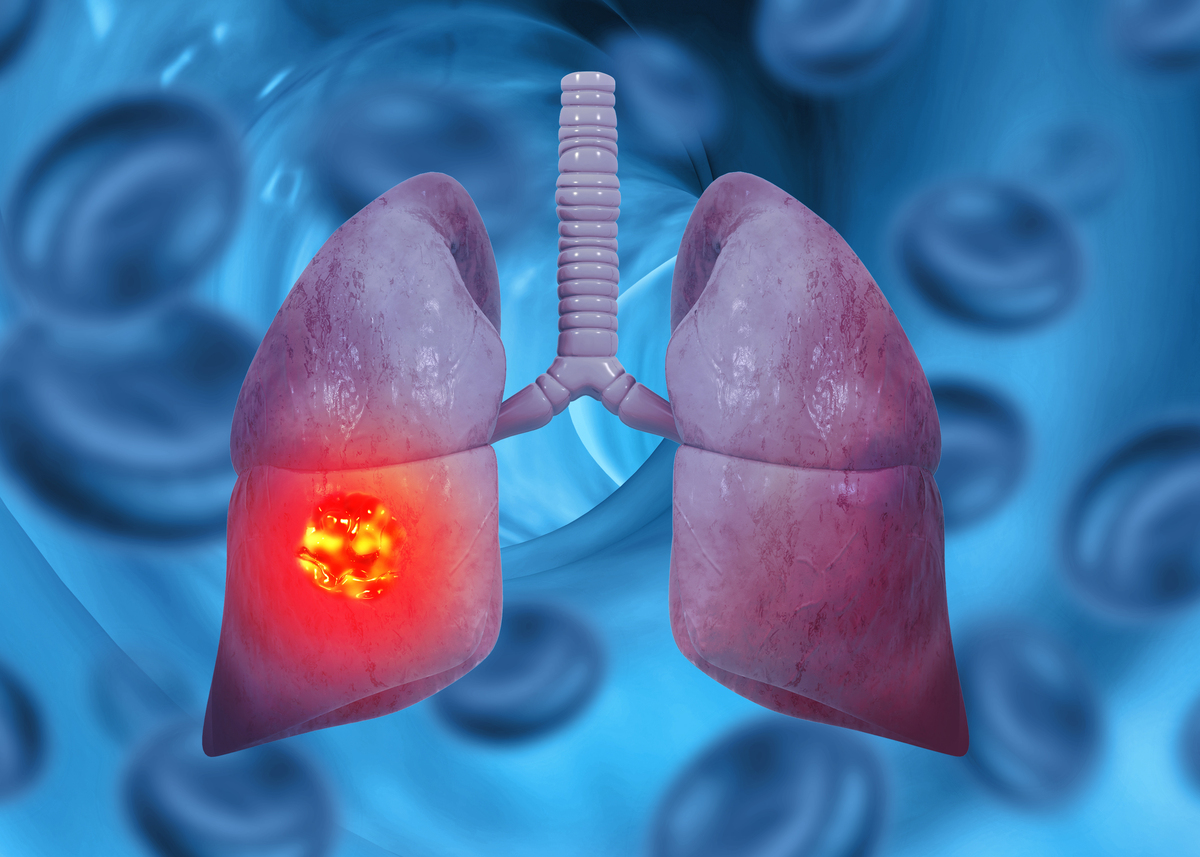给以下文案写一个标题党的标题肺结节一定会变成肺癌吗？离肺癌还有多远呢？我们不能仅仅以结节的大小来判断它的危险程度医生也无法一眼看出是良性还是恶性这也导致许多患者对小结节是否为肿瘤产生怀疑。要确定是否属于高风险人群首先要看是否符合以下条件：长期吸烟每年吸烟超过30包；患有肺气肿、慢性阻塞性肺病、间质性肺炎等肺部疾病；从事与化工厂、煤矿、切割大理石等相关职业或长期居住在相关场所附近接触石棉、砷、铍、镉