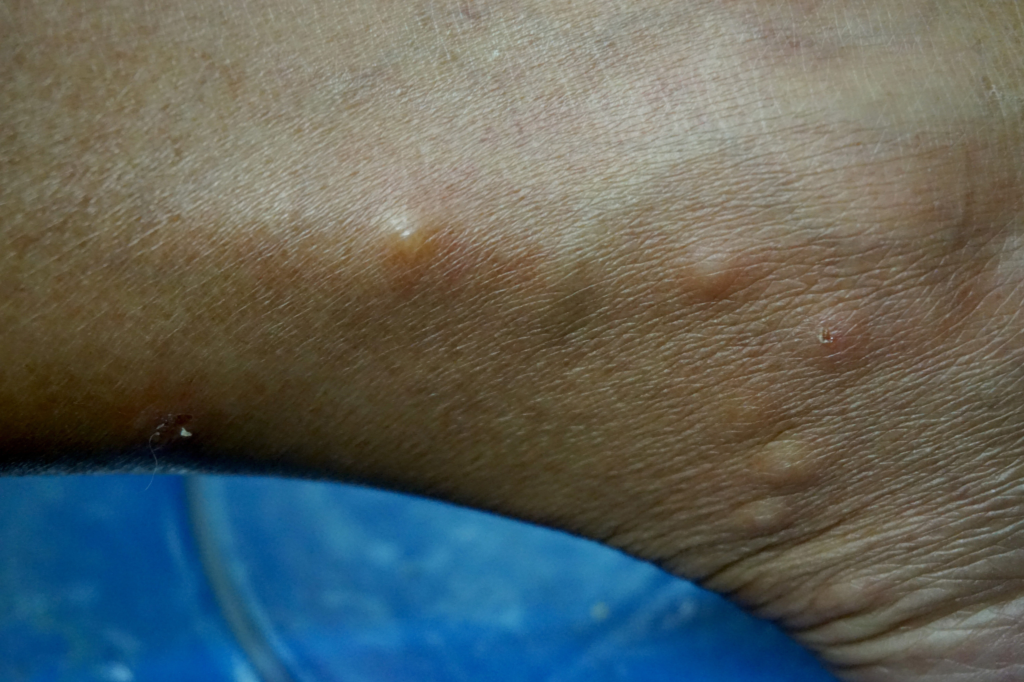 close up around ankle of woman with rash cause from bed bugs bit