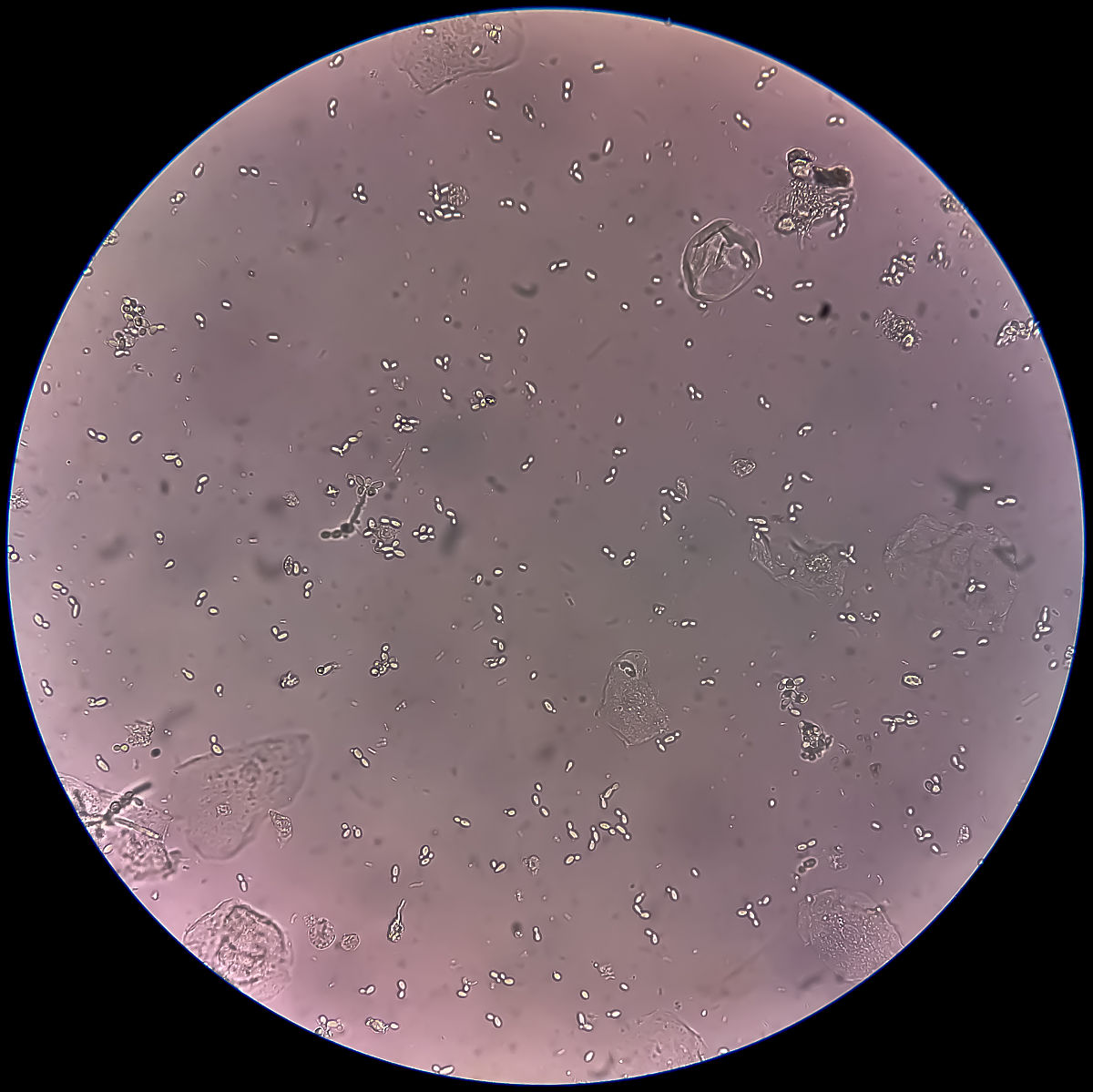 肾小球源性血尿与非肾小球源性血尿的鉴别