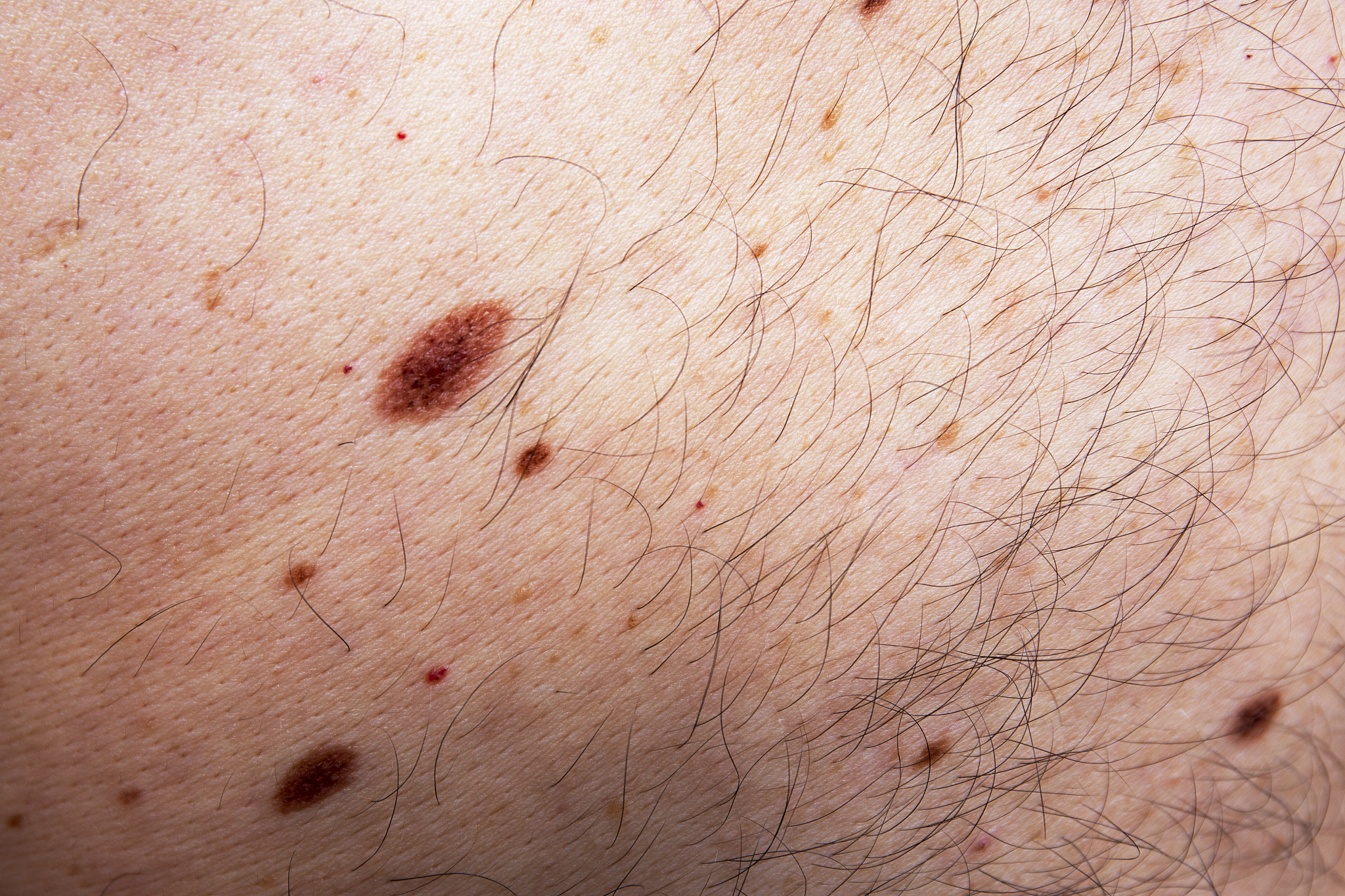 skin disease on caucasian man bust