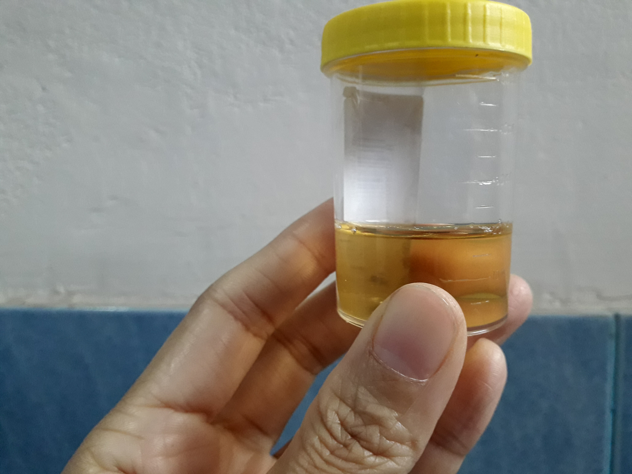 血常规检查后淋巴细胞百分率161淋巴细胞计数13510^9L中心粒细胞百分率761流感A、B抗原检测都是阴性是什么情况？