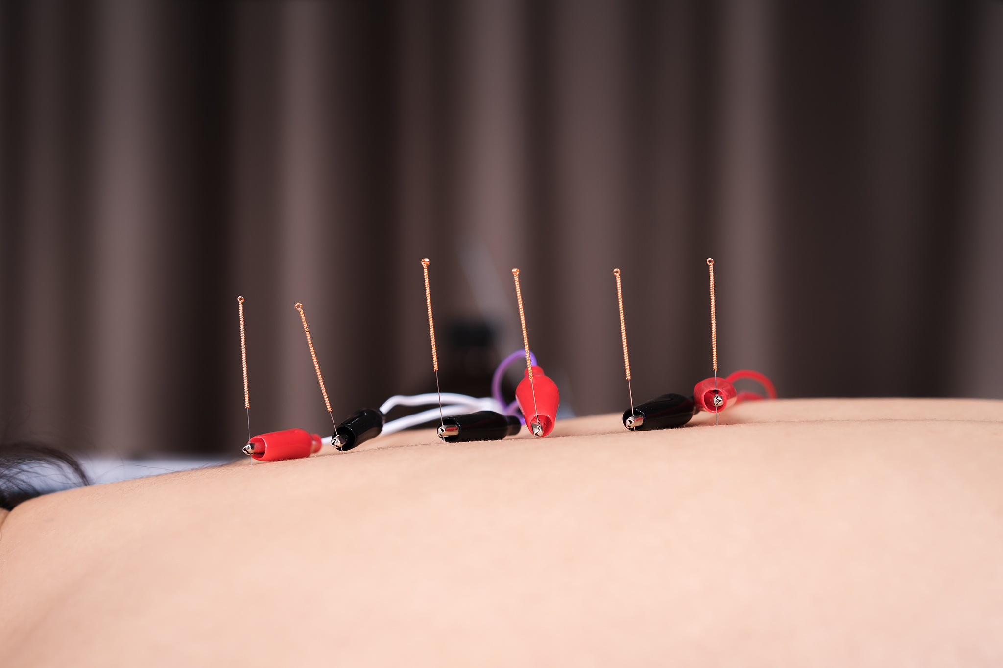 close-up of person getting acupuncture therapy