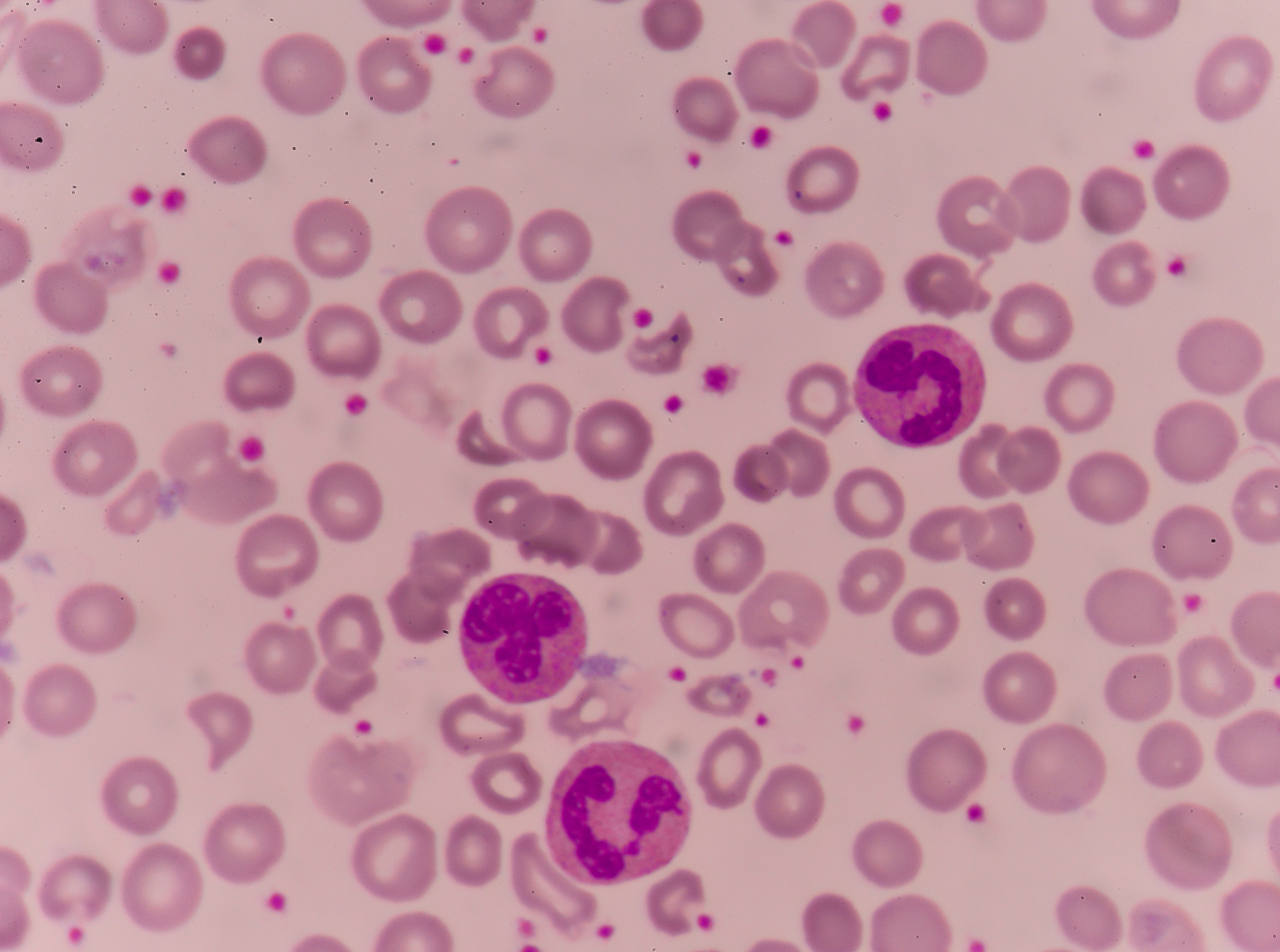 疱疹性咽颊炎血常规异常解读：红细胞压积低、血小板分布宽度高、白细胞计数低等意味着什么？