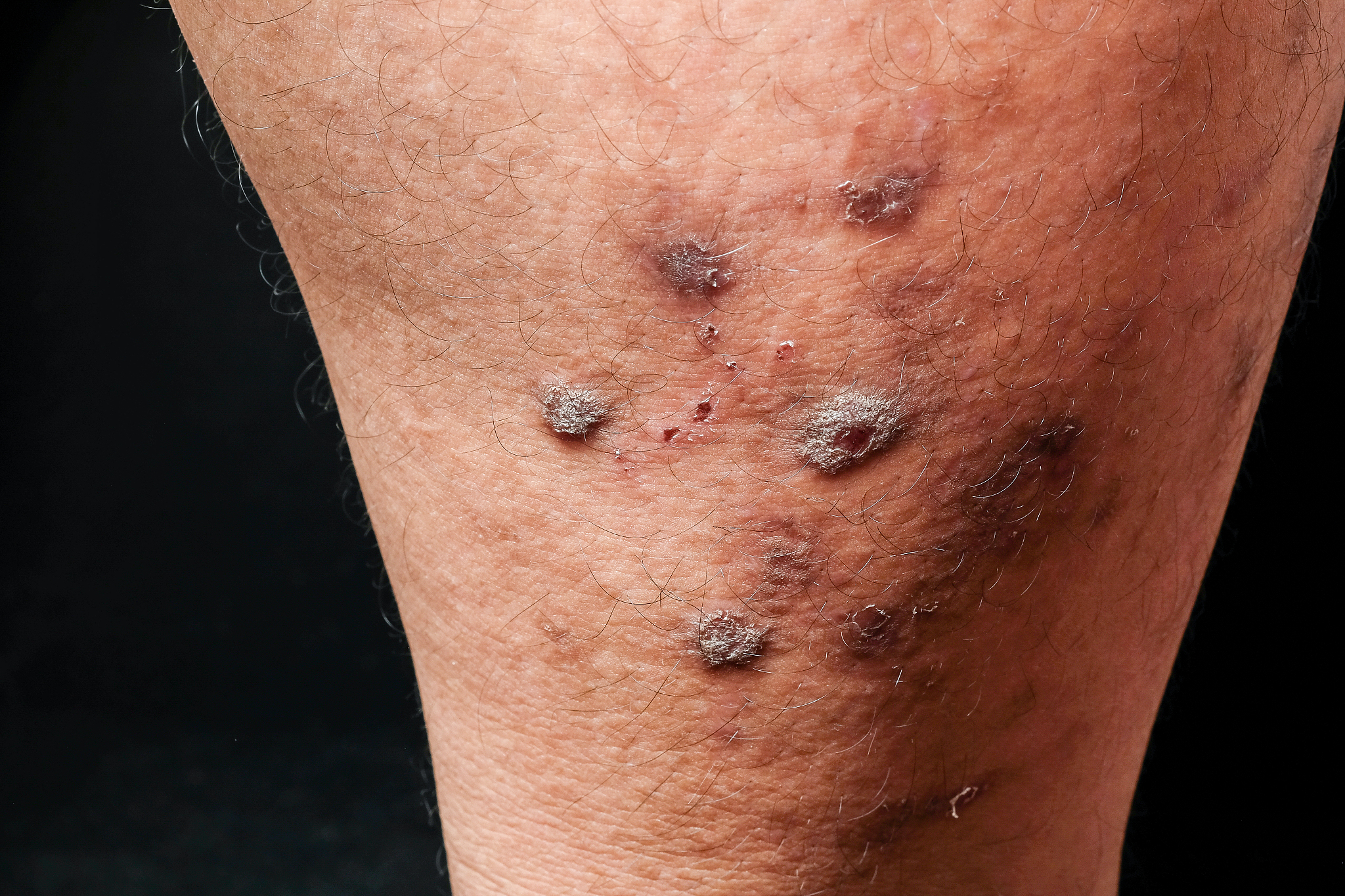 closeup dermatitis detail