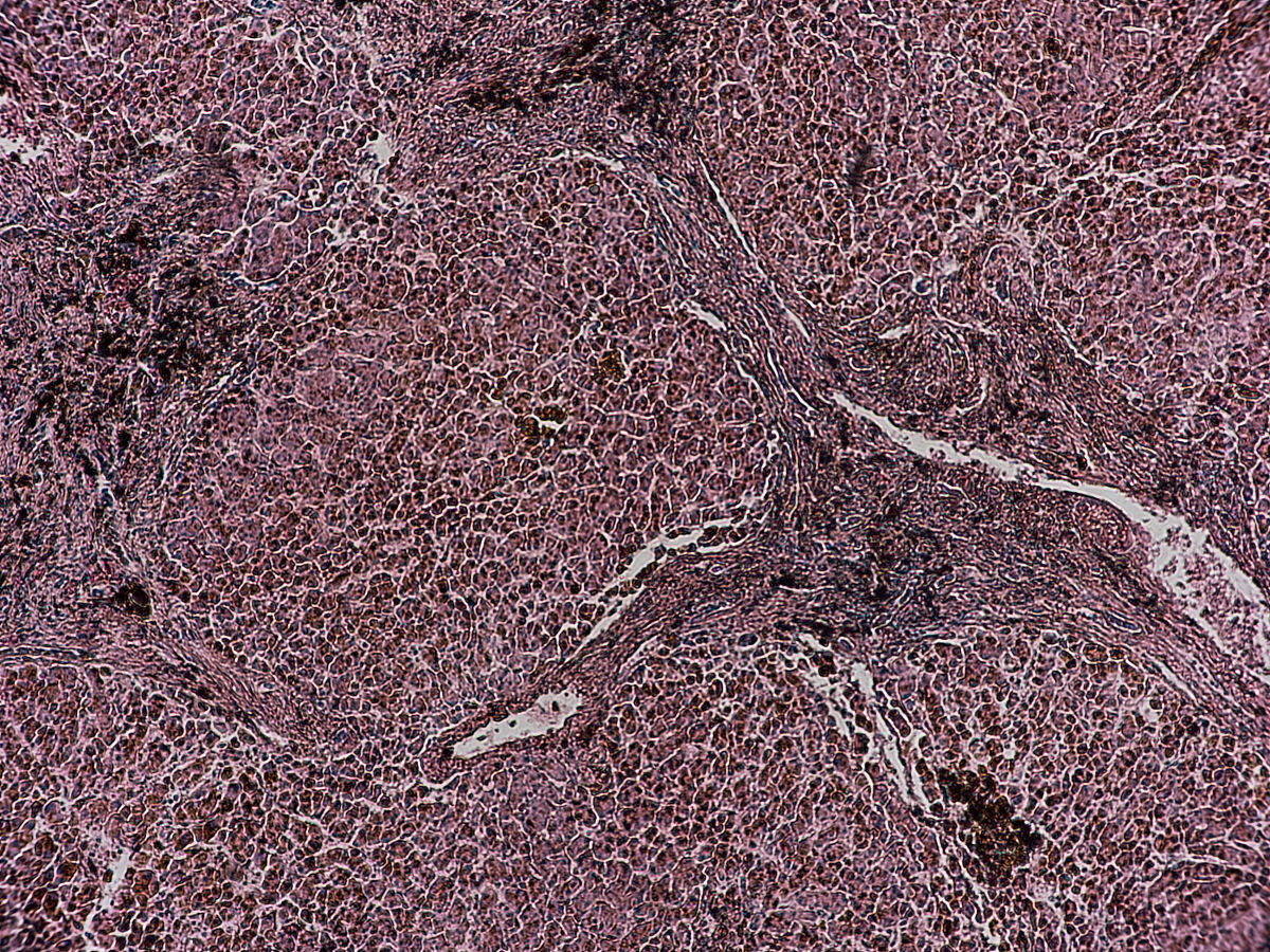 肝衰竭的诊断标准