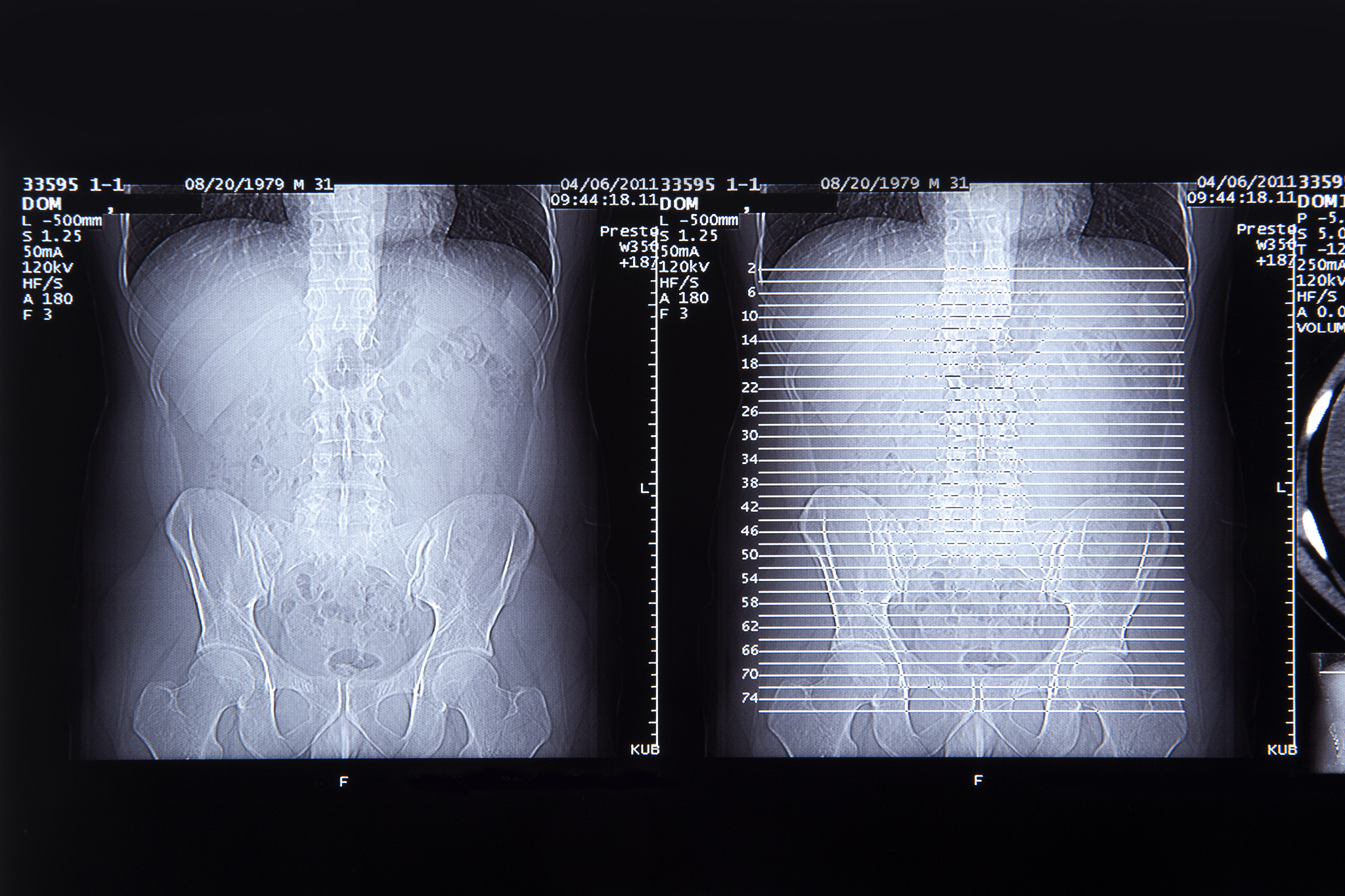 语法错误分析：Swin Unet, Transunet 和 U-Net 在医学影像分割中的比较