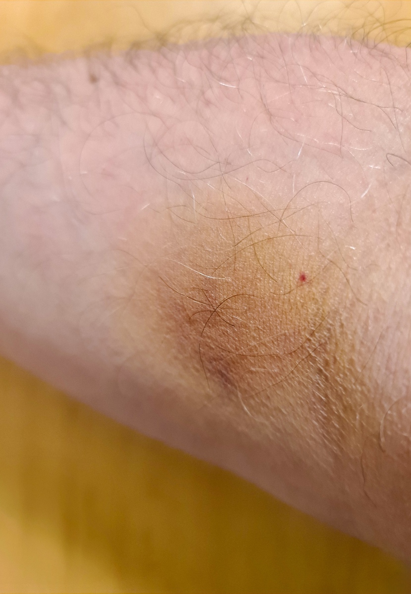 鸡皮刺螨：症状、原因和治疗方法