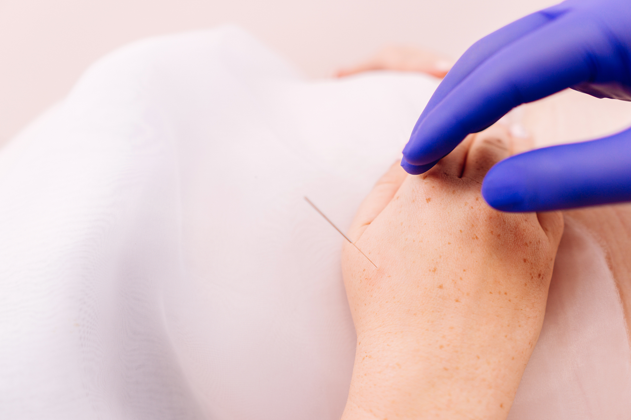 young woman getting acupuncture treatment