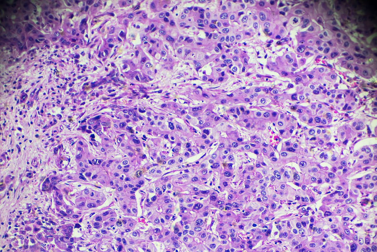 肝 低密度 不强化 间质瘤